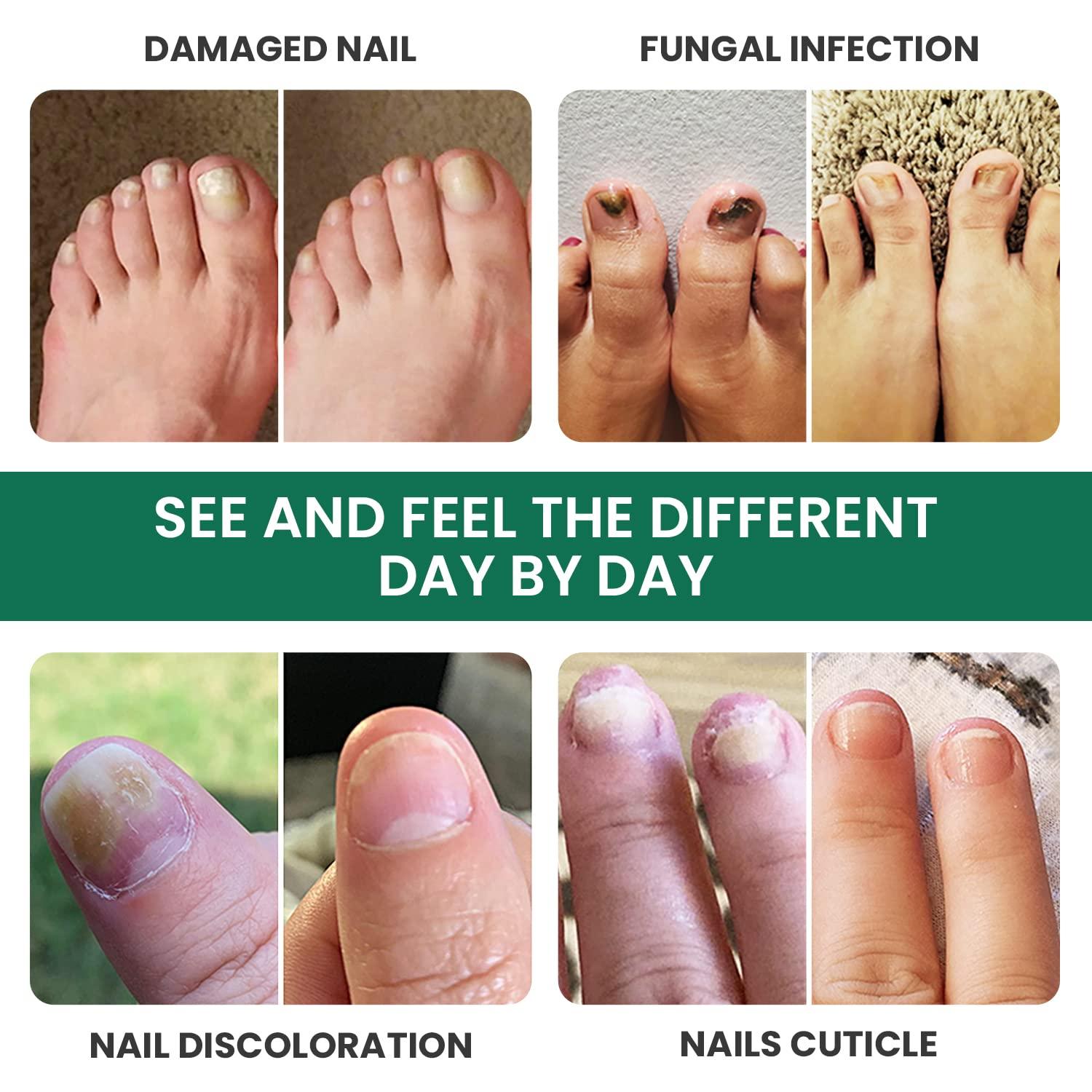 Extra Strength Toenail Fungus Treatment - Made In USA, Nail Fungus Solution  for Toe Nail & Fingernails - Fix Thick, broken & Fungal Discolored Nails-  Renew Fungi Damaged Nail, & Cracked Nails