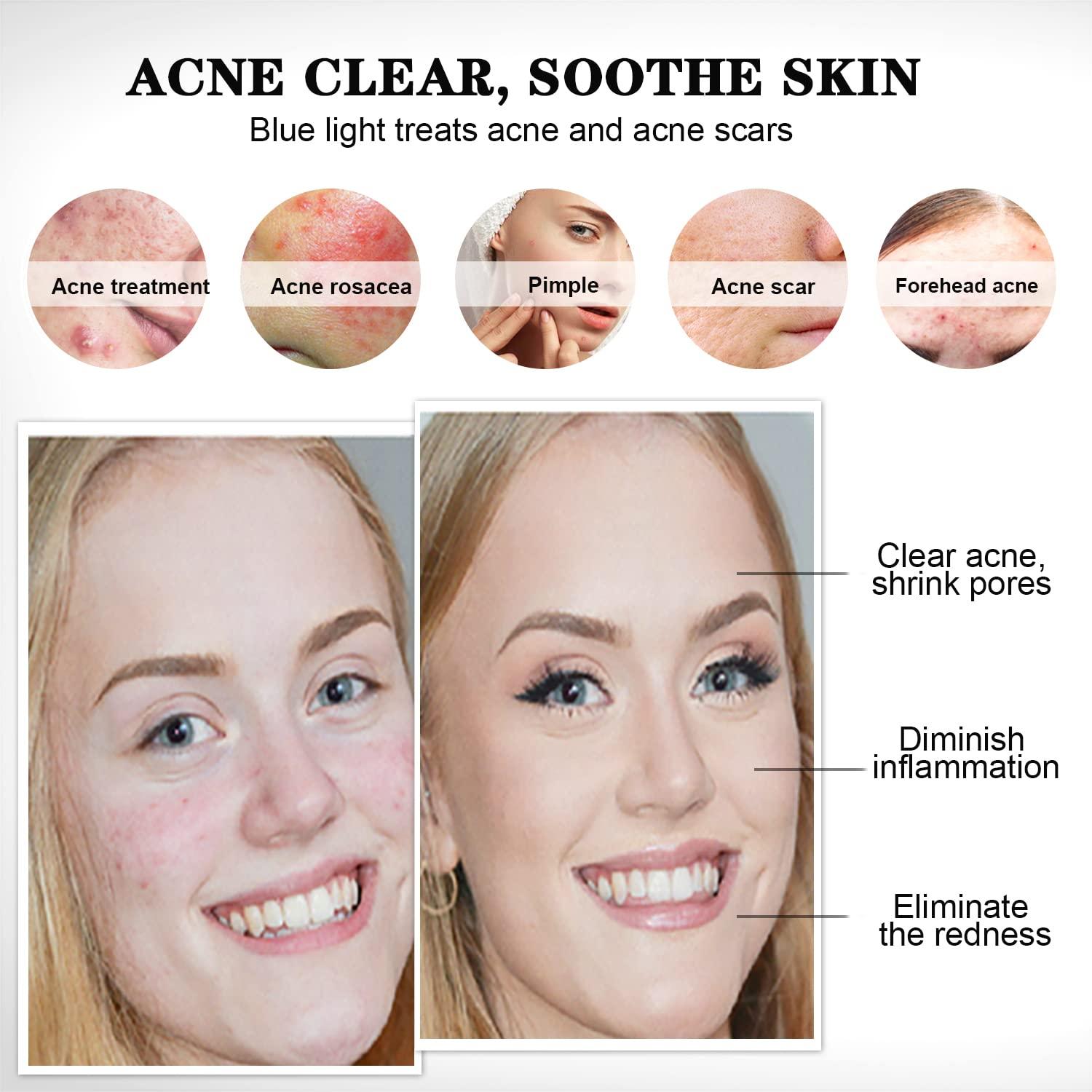 Blue Light For Acne Rosacea Shelly Lighting