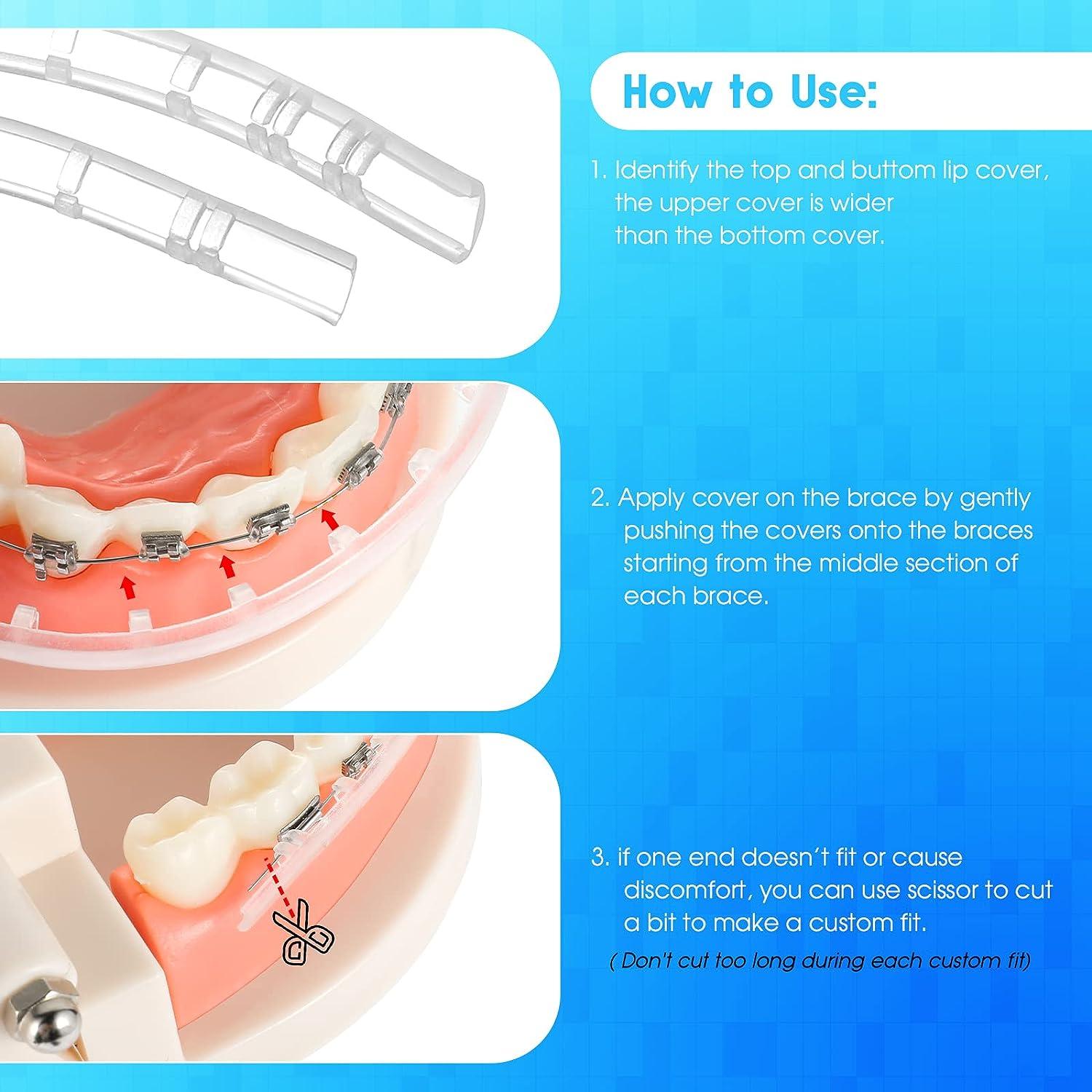 Obrush Clipon Comfort Covers for Braces Orthodontic Lip Protector