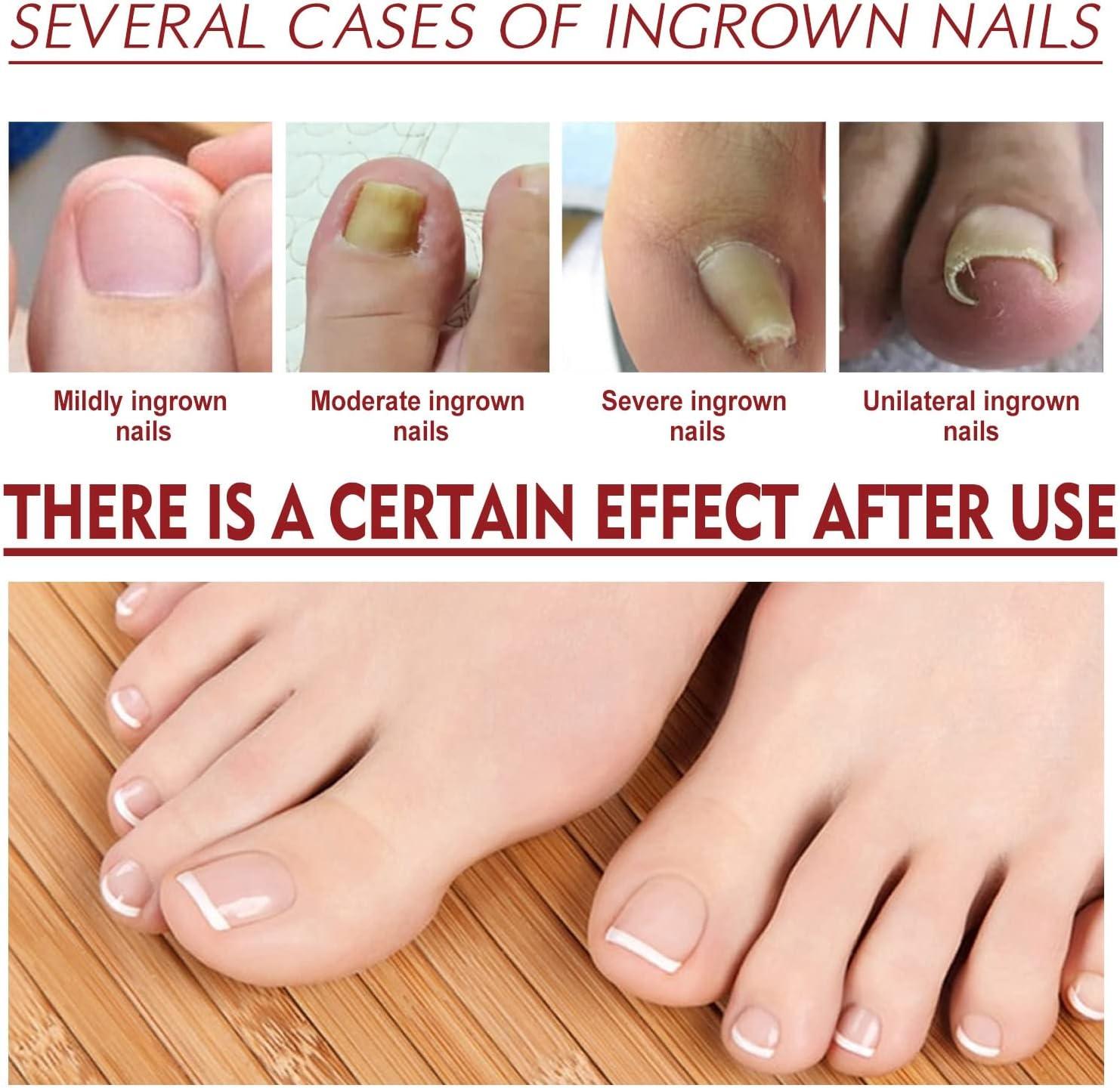 2PCS Ingrown Toenail Treatment Anti Paronychia Relief Oil Ingrowing