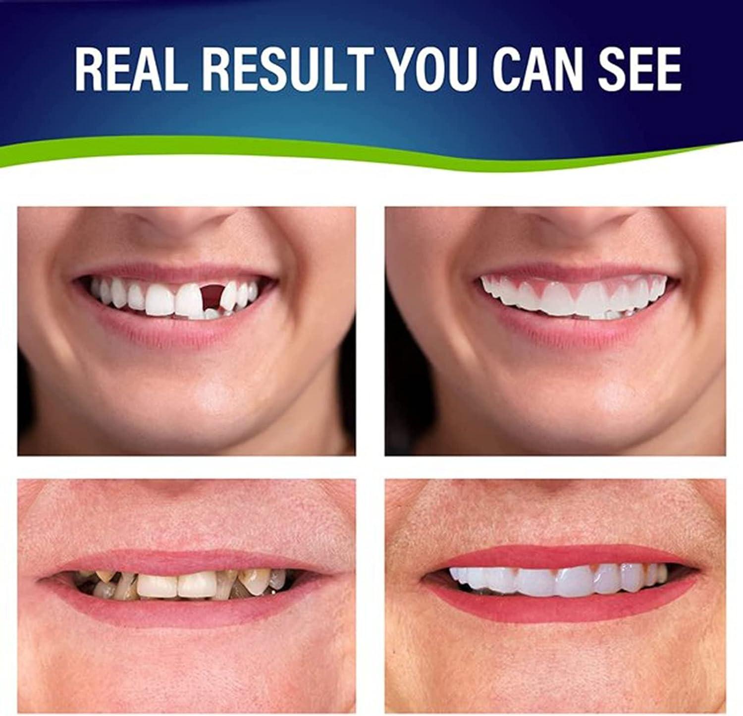 BEGUT Fake Teeth Cosmetic Denture Veneers for Upper and Lower Jaw Natural Shade Fake Veneer for