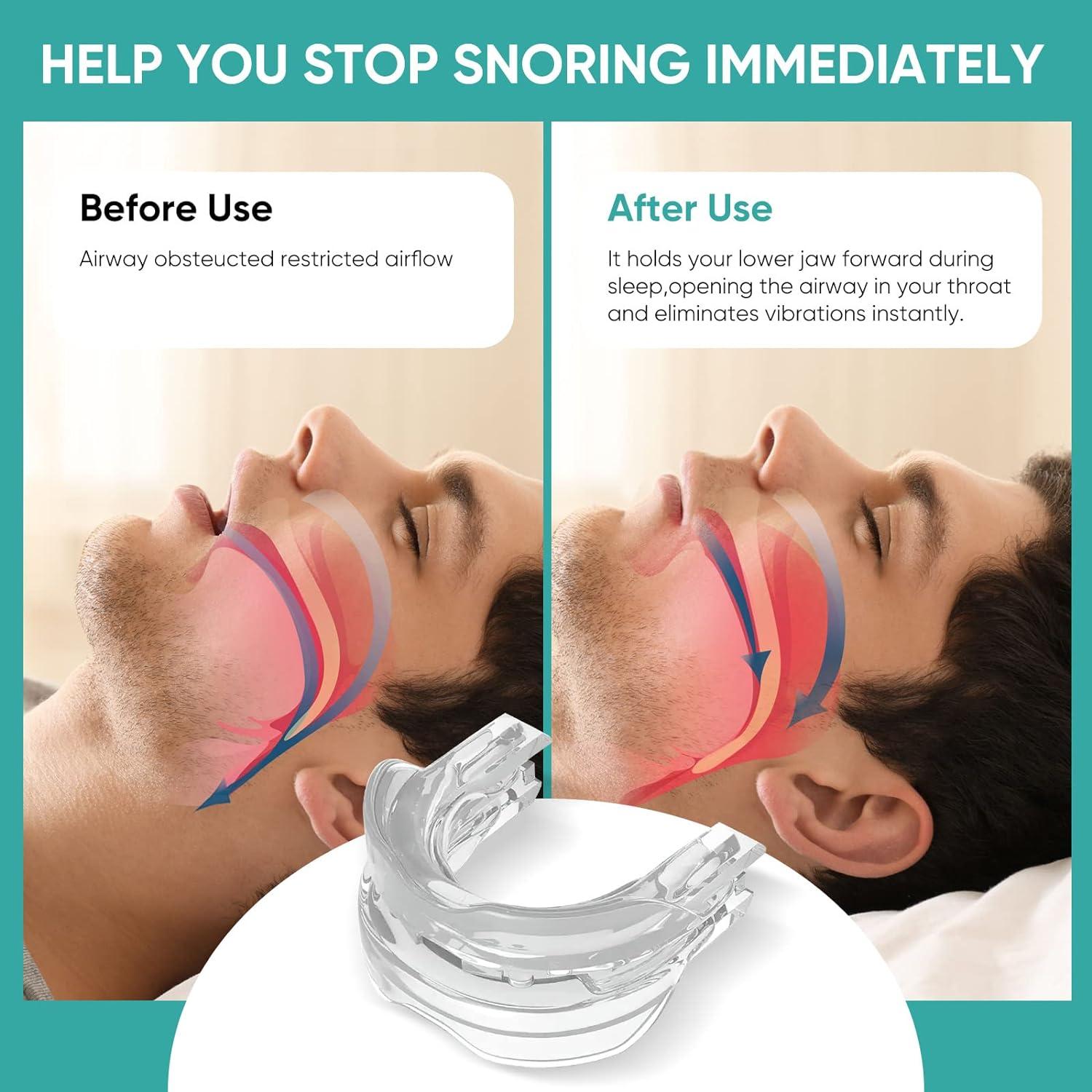 SnoringAidsforMen/WomenAntiSnoreDevicesMouthpiece New Anti
