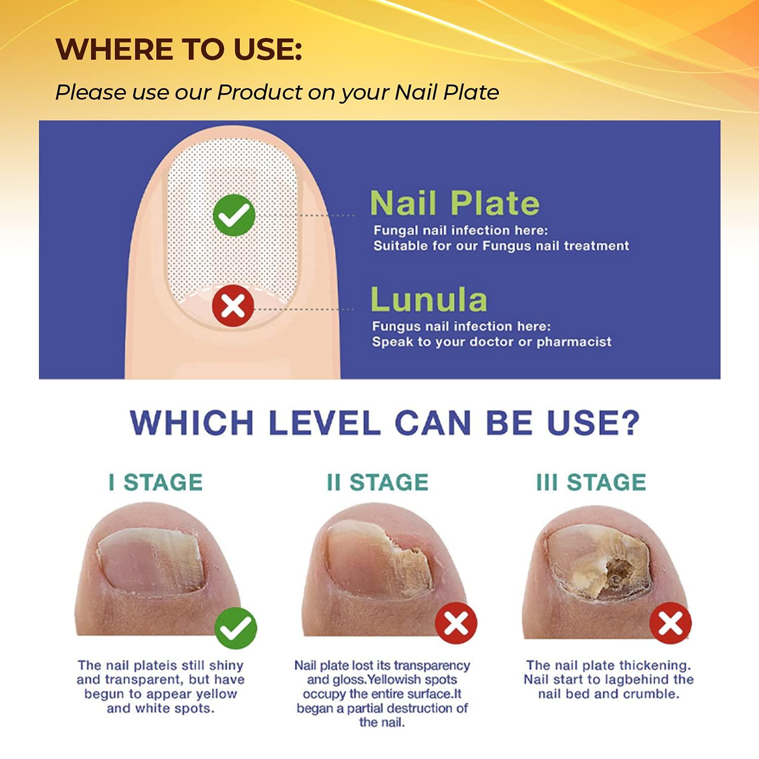 Nail Repair Treatment for Toe and Fingernail Fungal Repair Maximum Strength Hydrates Nail