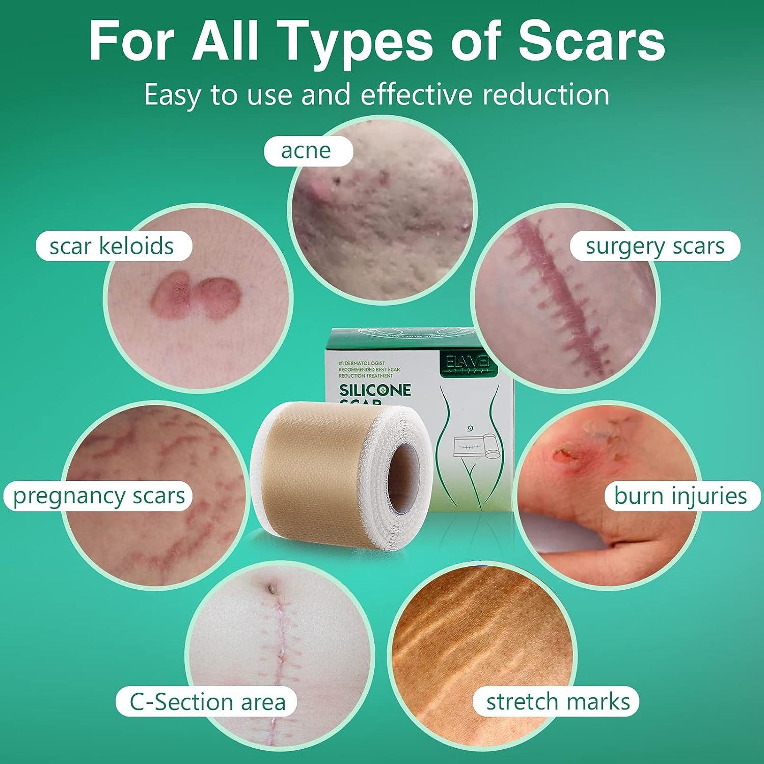 Silicone Scar Sheets for Scars Removal Silicone Scar Tape Medical