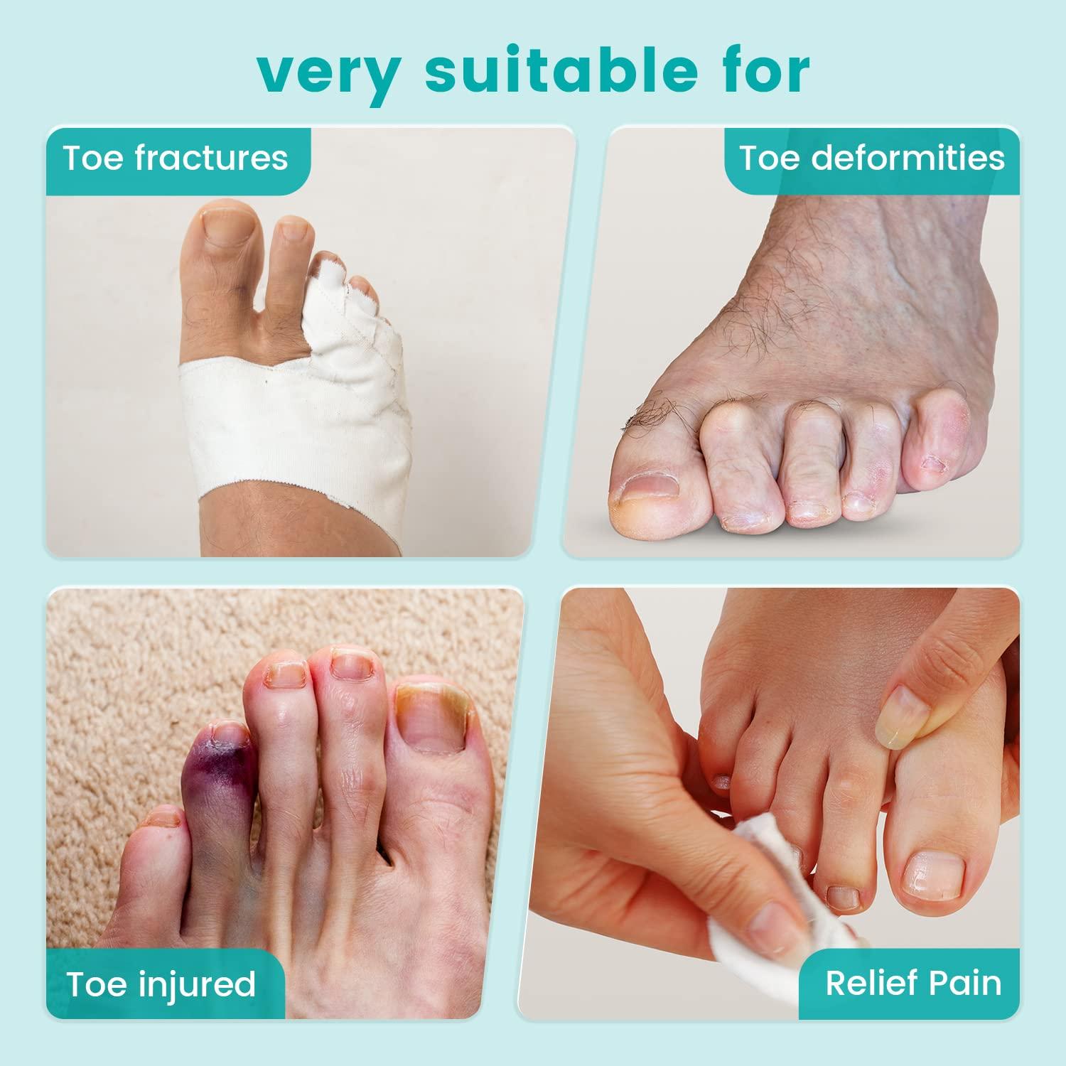 Toe Splint UShaped Toe Corrector Brace Toe Straightener of Adjustable