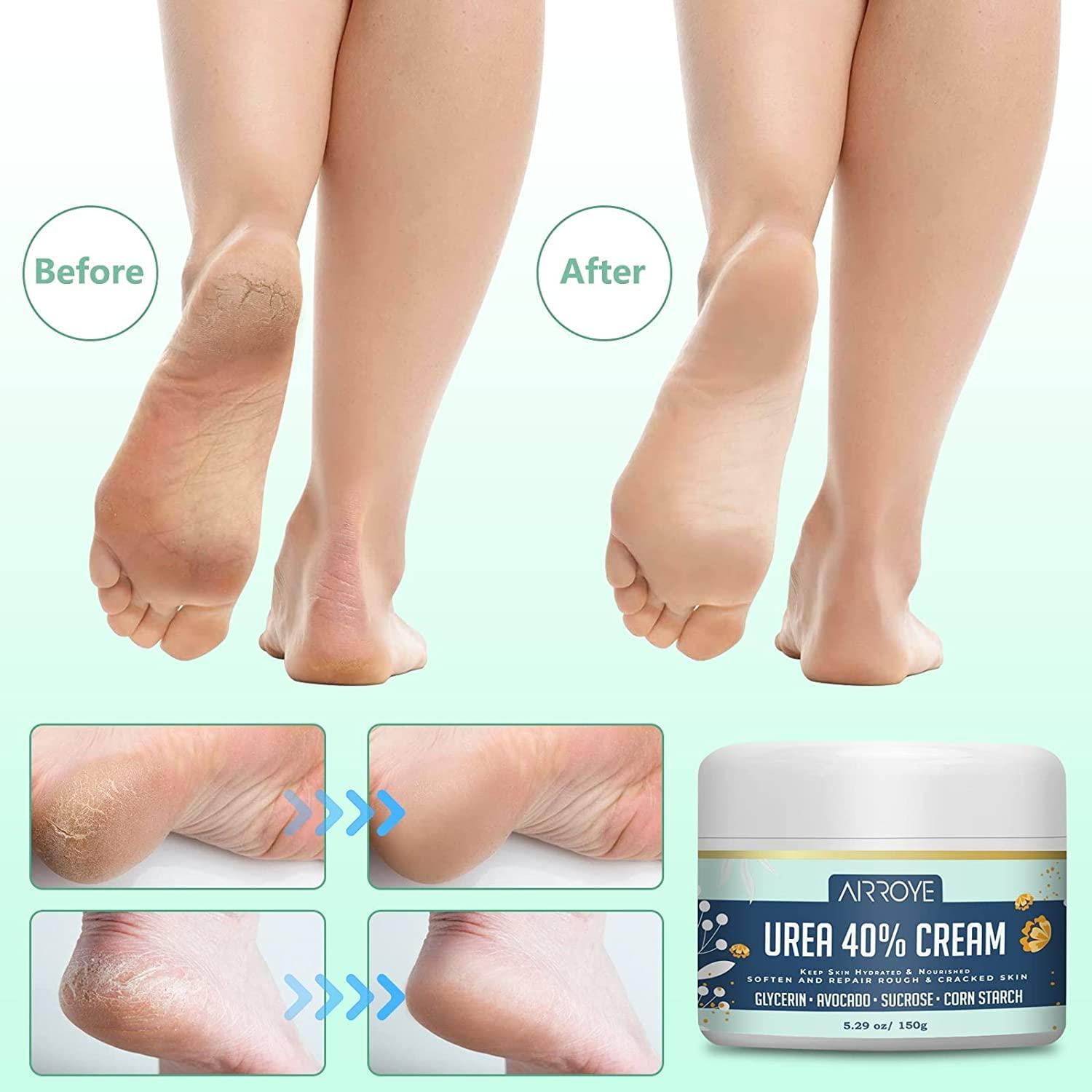 Urea Cream 40 percent for Feet Maximum Strength Best Callus ...