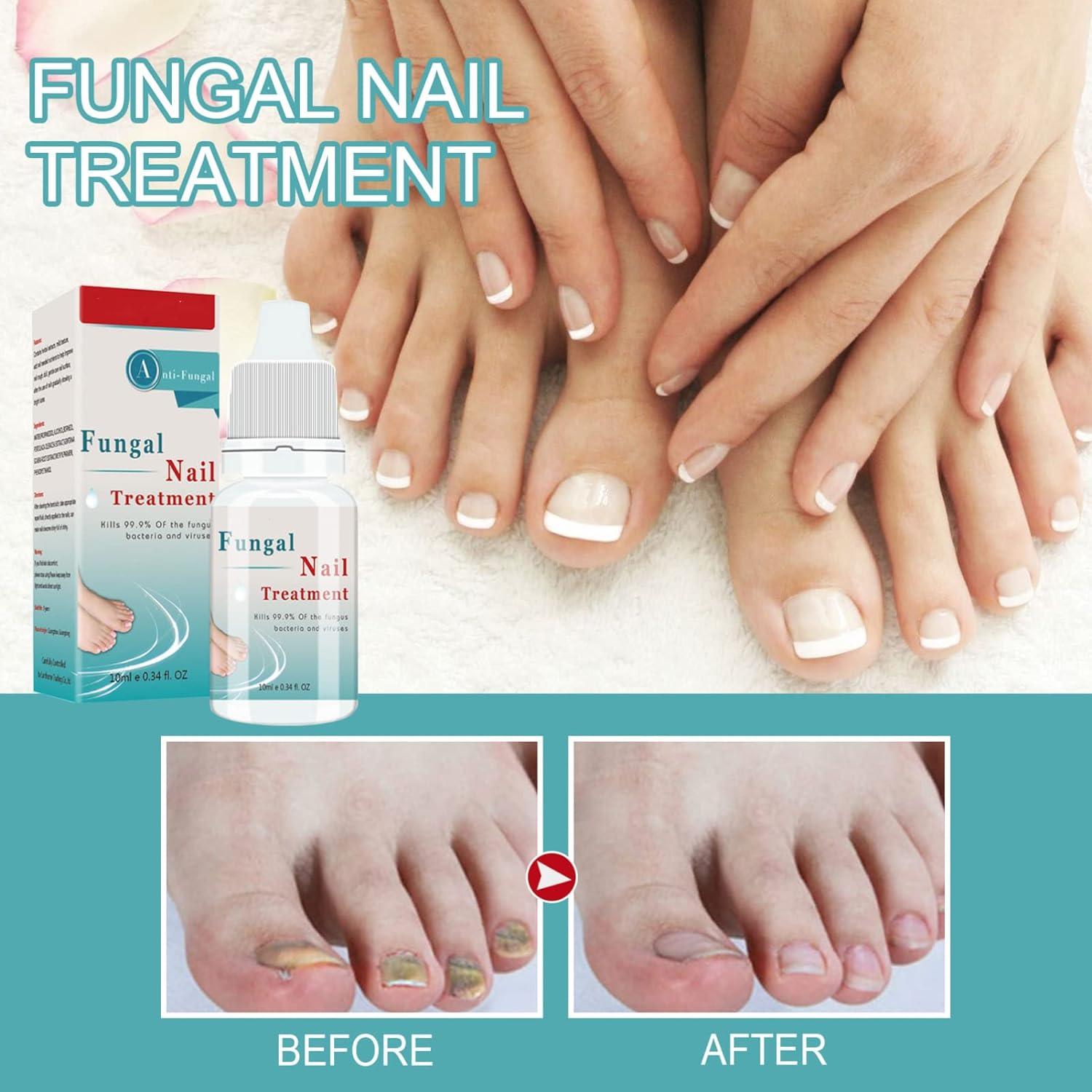 Fungal nail treatment Nail Fungus Treatment Anti fungal Nail Solution