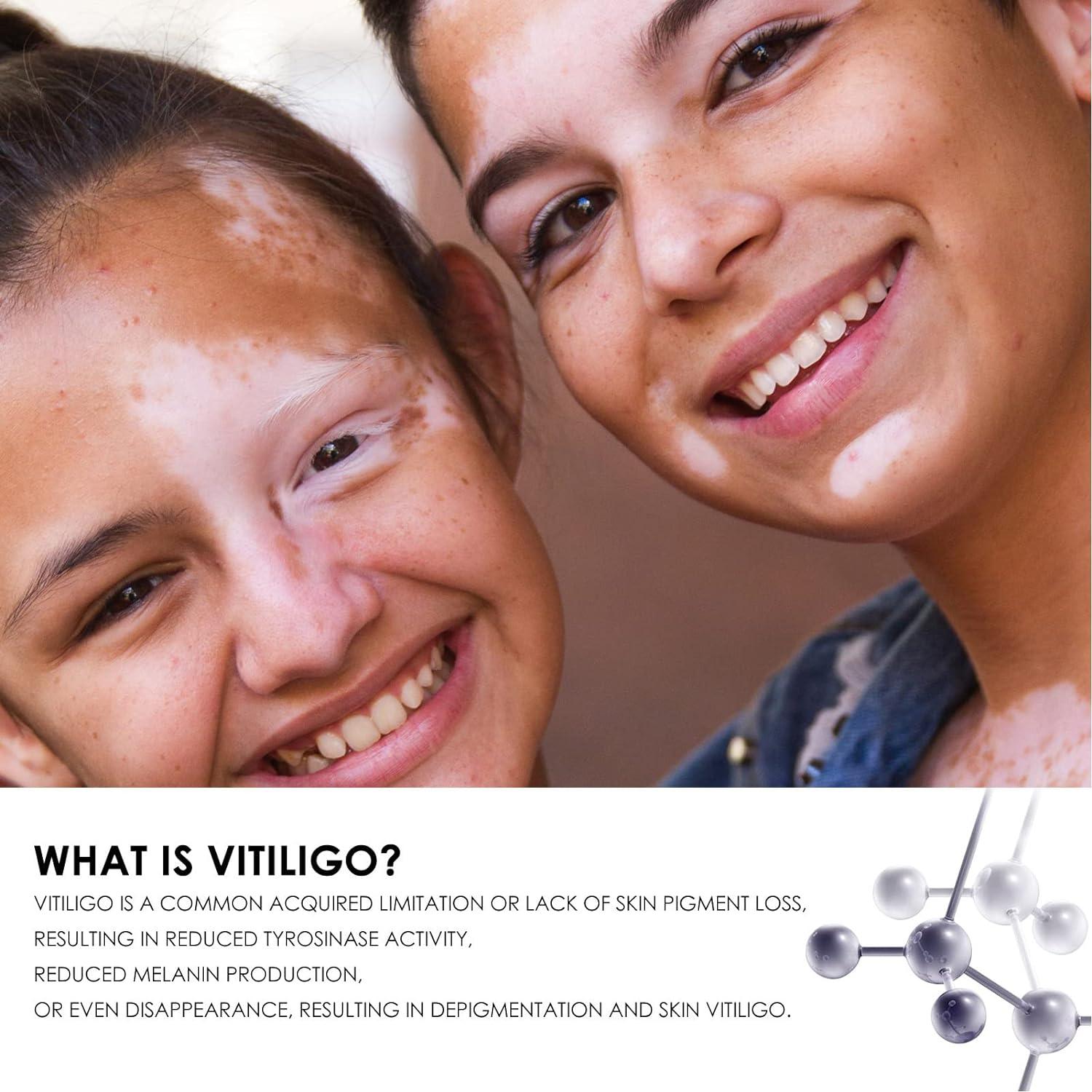 Skin Vitiligo Spray Whitening Vitiligo Care Spray Easy to Use