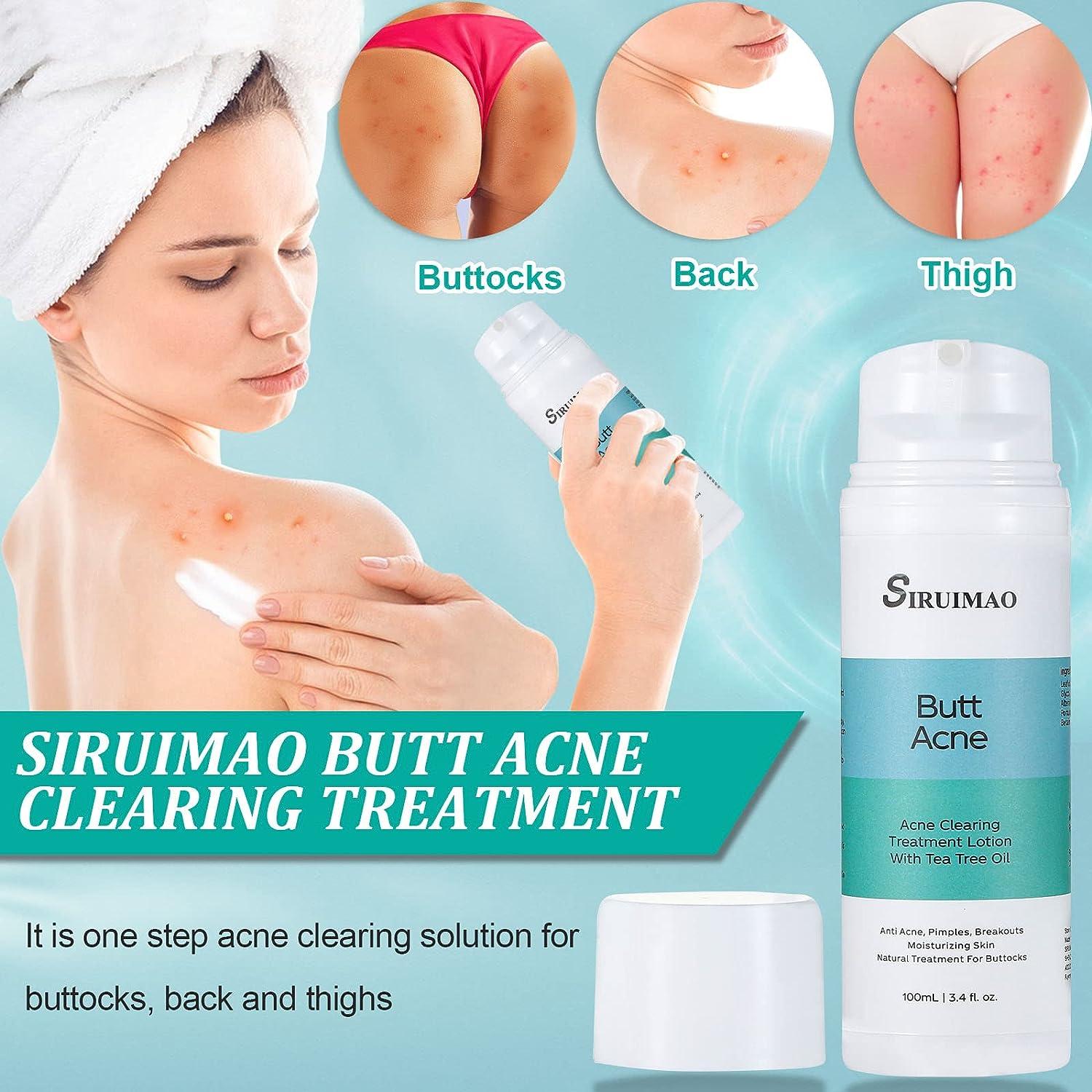 SIRUIMAO Butt Acne Clearing Treatment 3.5oz Bum Acne Treatment for