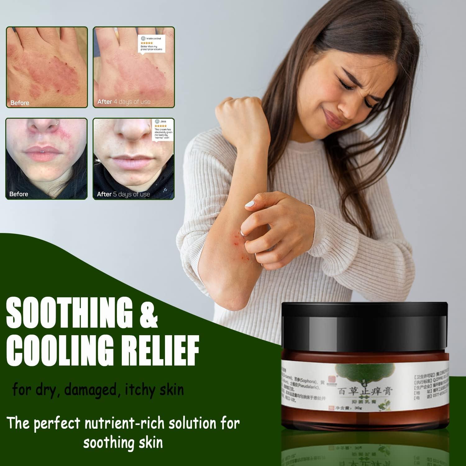AllNatural Eczema & Psoriasis Cream for Sensitive Skin Herbal Anti