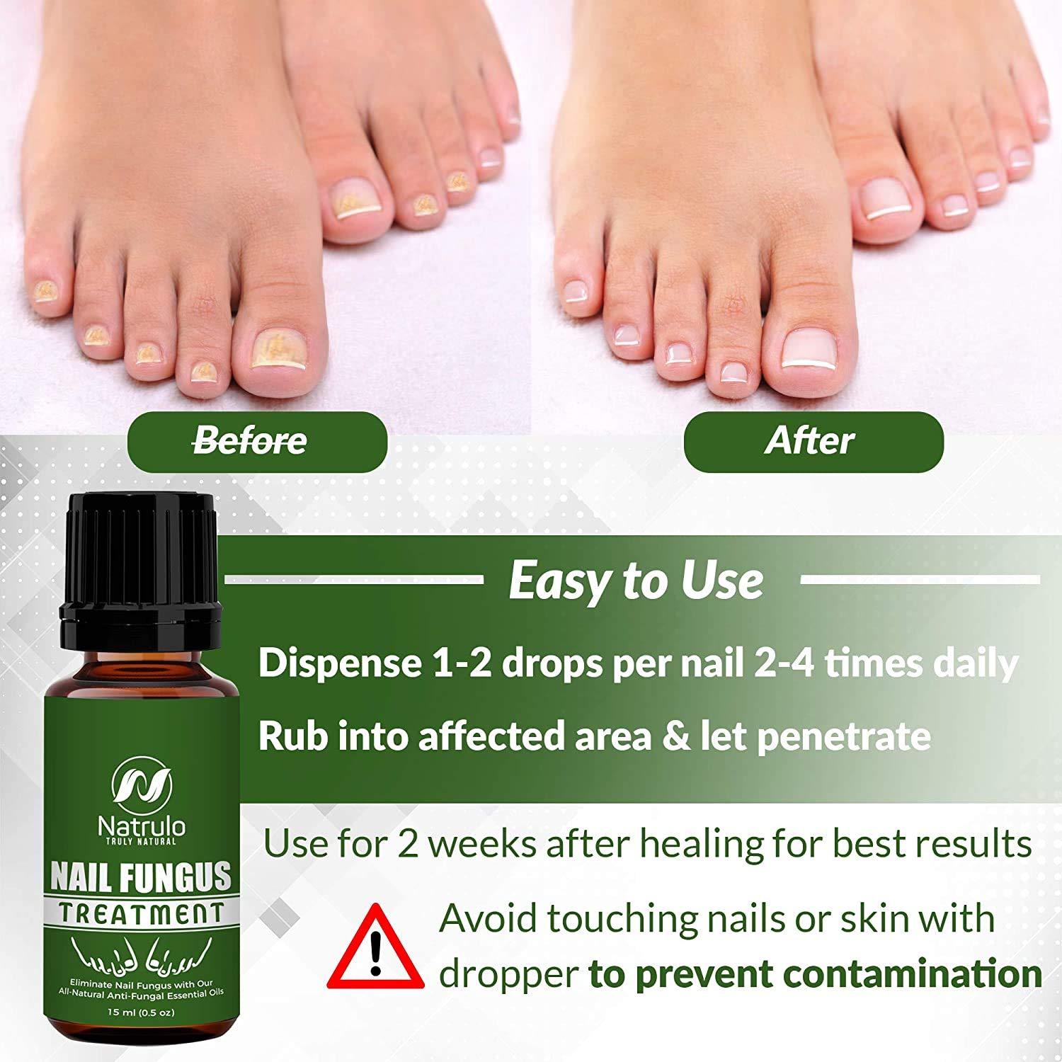 Nail & Toenail Fungus Treatment Natural Anti Fungal Nail Balm with