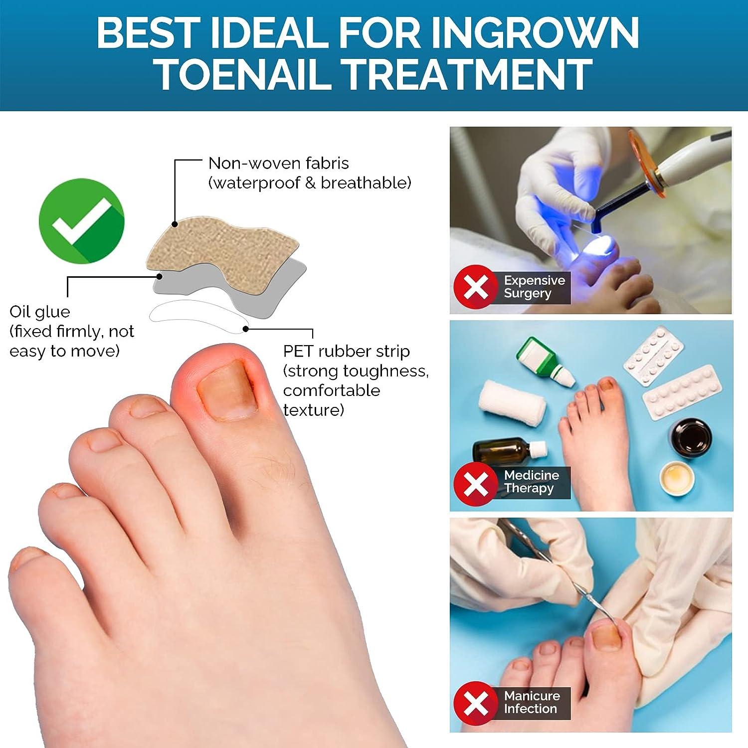 Ingrown Hairs Cat Ingrown Toenail Ingrown Toenail Treatment
