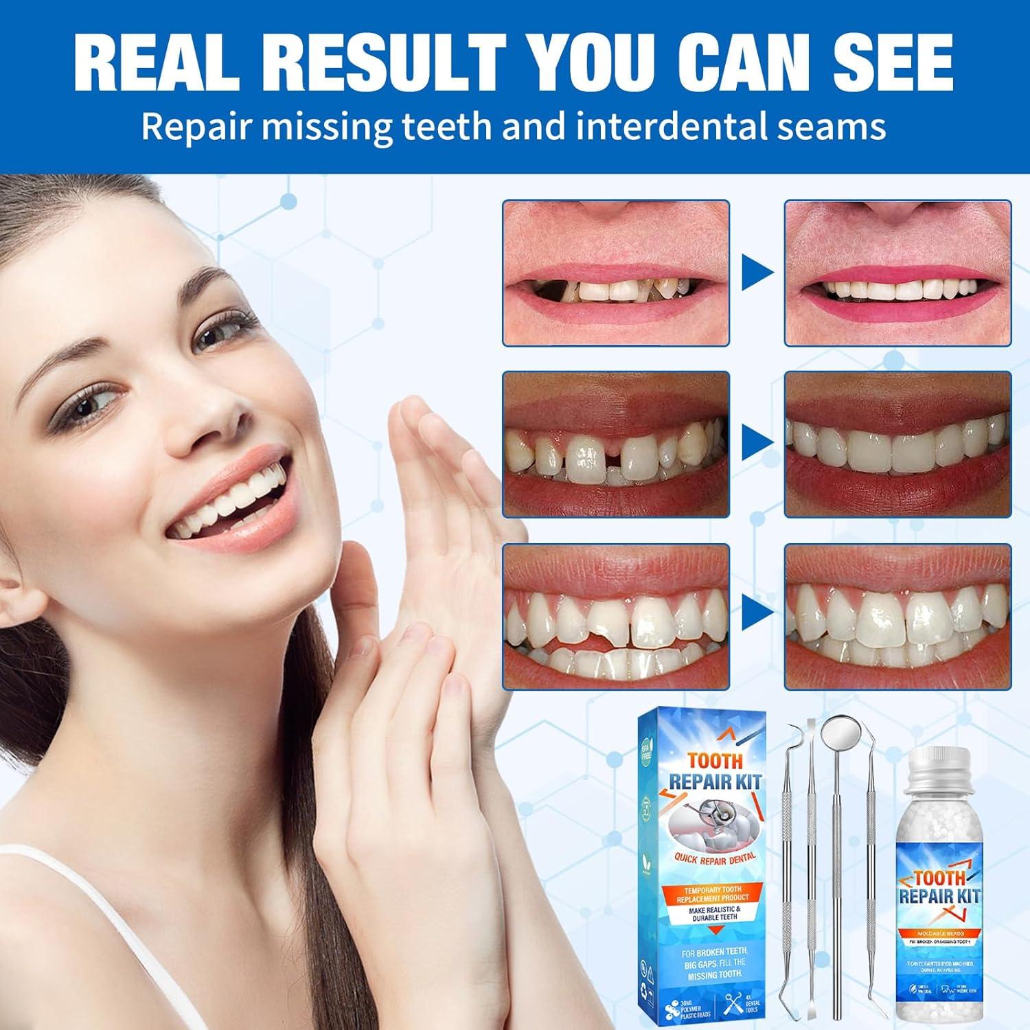 Miioto Tooth Repair Set - DIY Dental Adhesive & Temporary Prosthesis ...