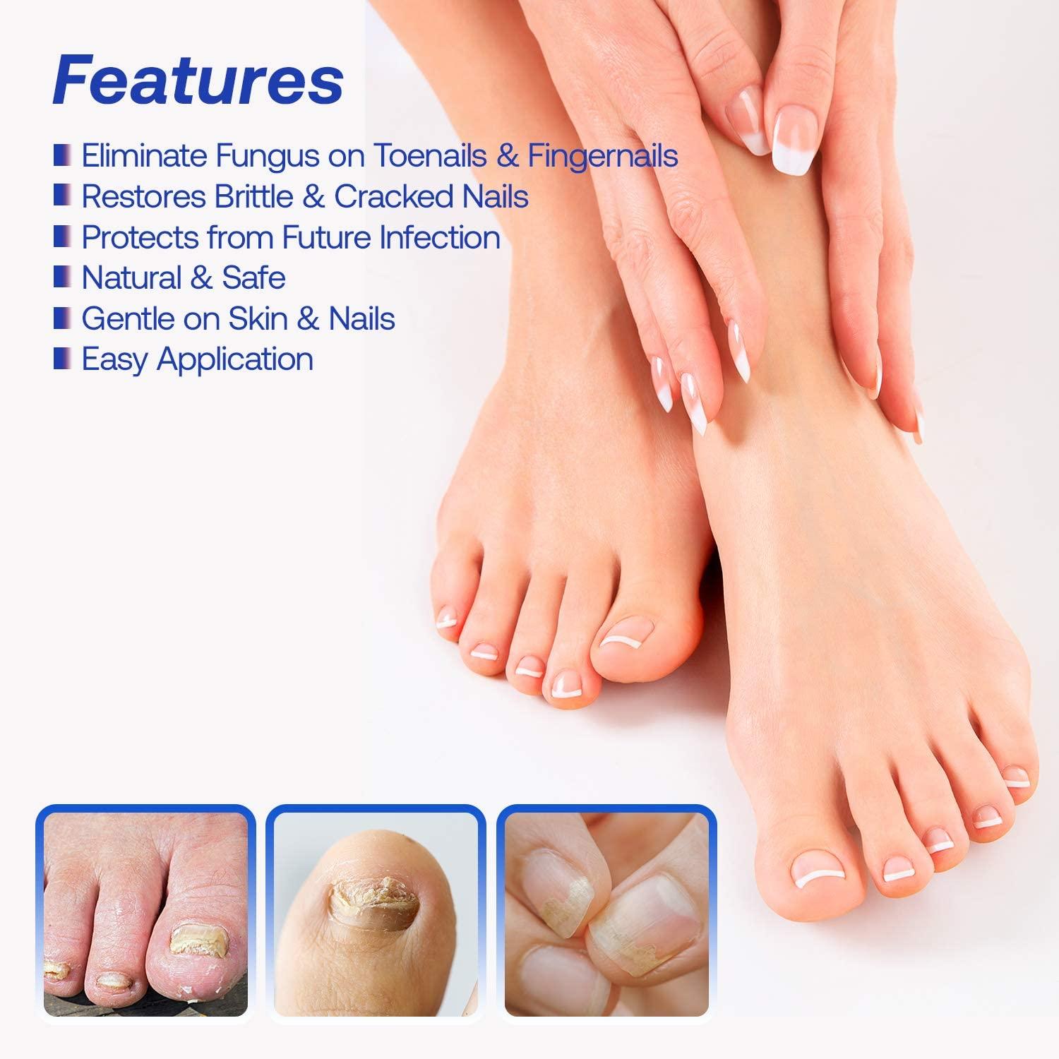 Nail Repair Cream, Effective Toenail Fungus Treatment Fungus Remover Foot Nail  Repair Cream Restores,20g - Walmart.com