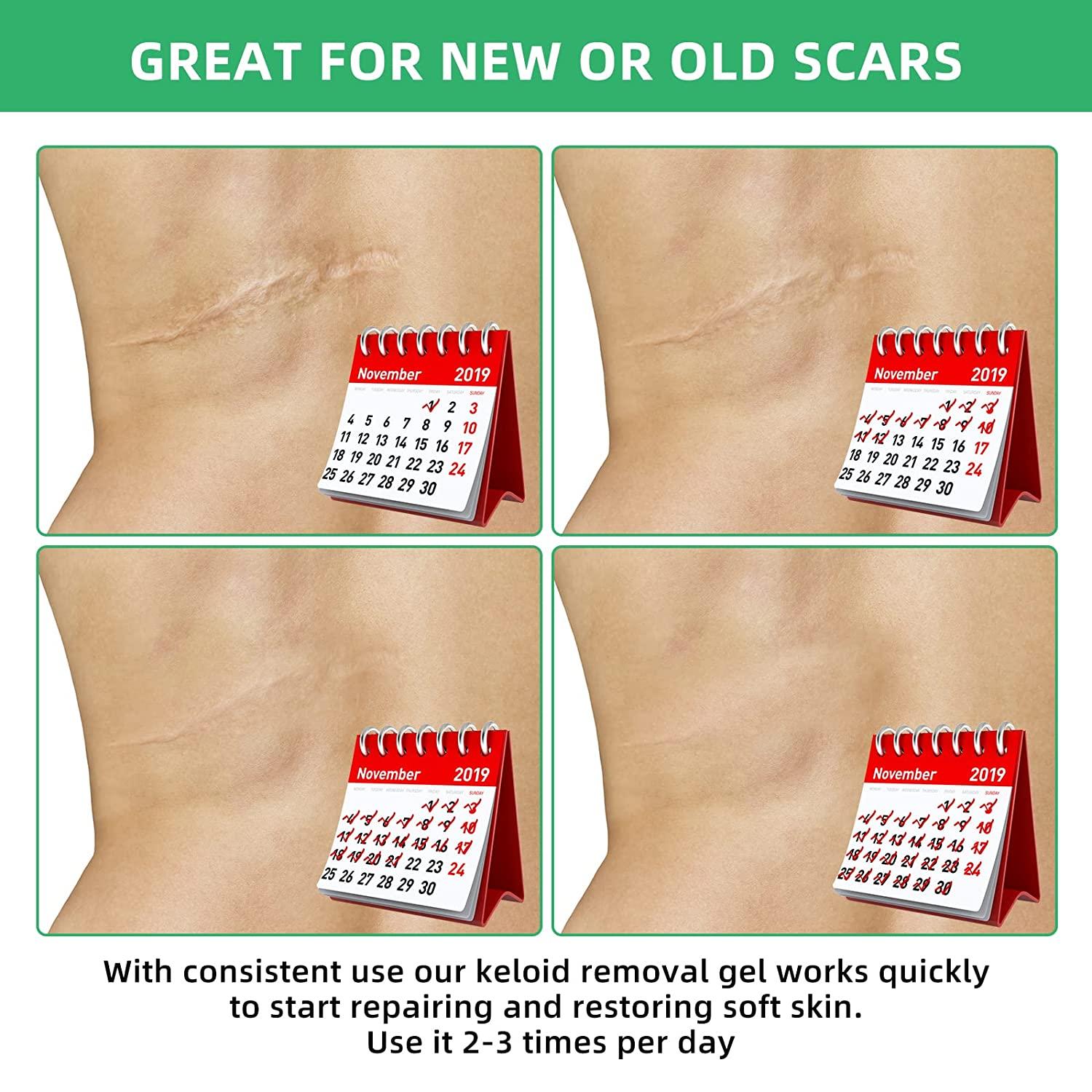 Tobcharm Keloid Scar Removal Gel Effective Treatment for Piercing