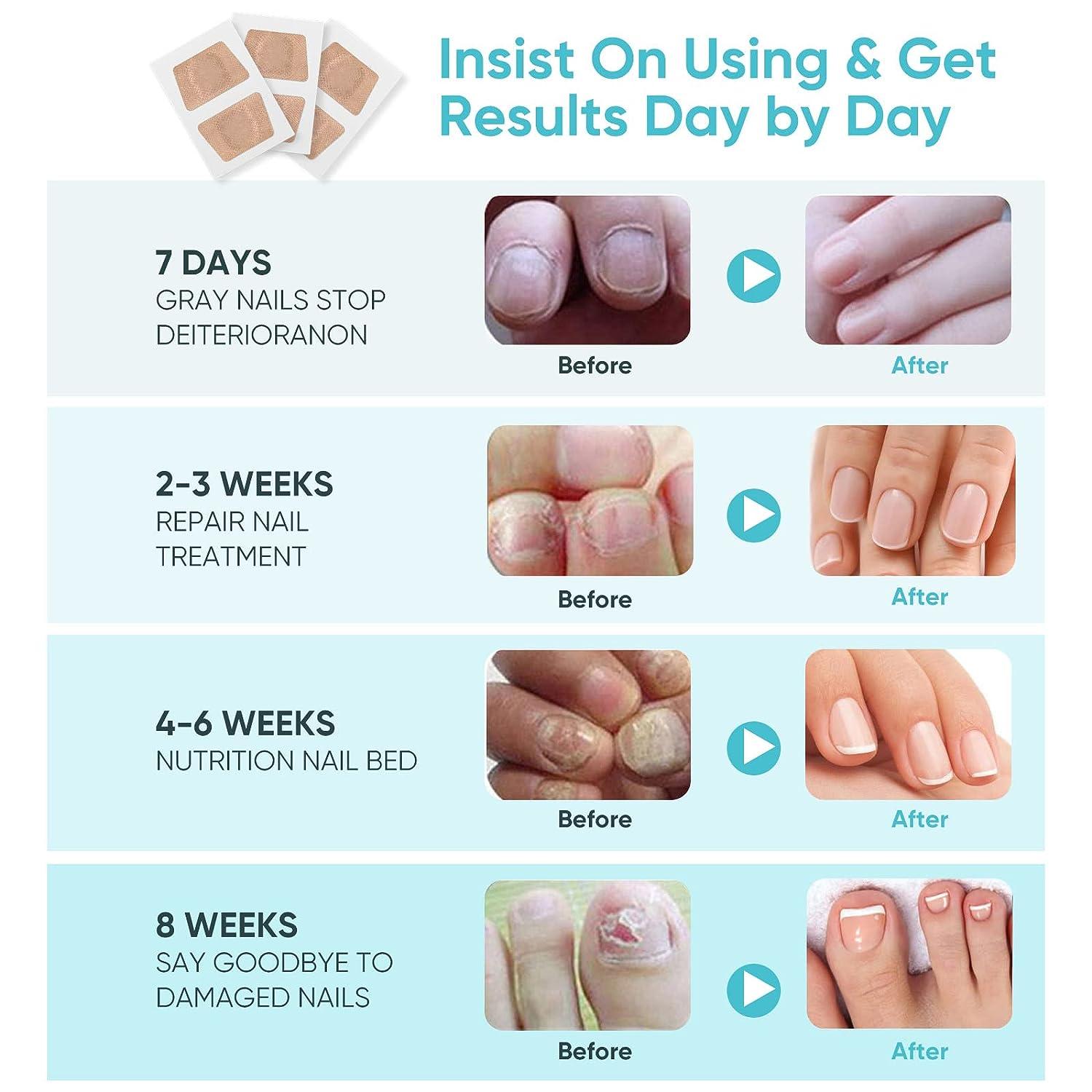 16pcs Nail Repair Strips Extra Strength Toenail Fungus Treatment