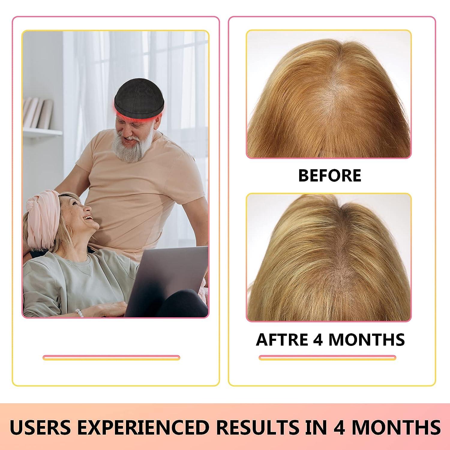 iKeener Laser Hair Regrowth Cap (FDA Cleared) Red & Blue Light Hair