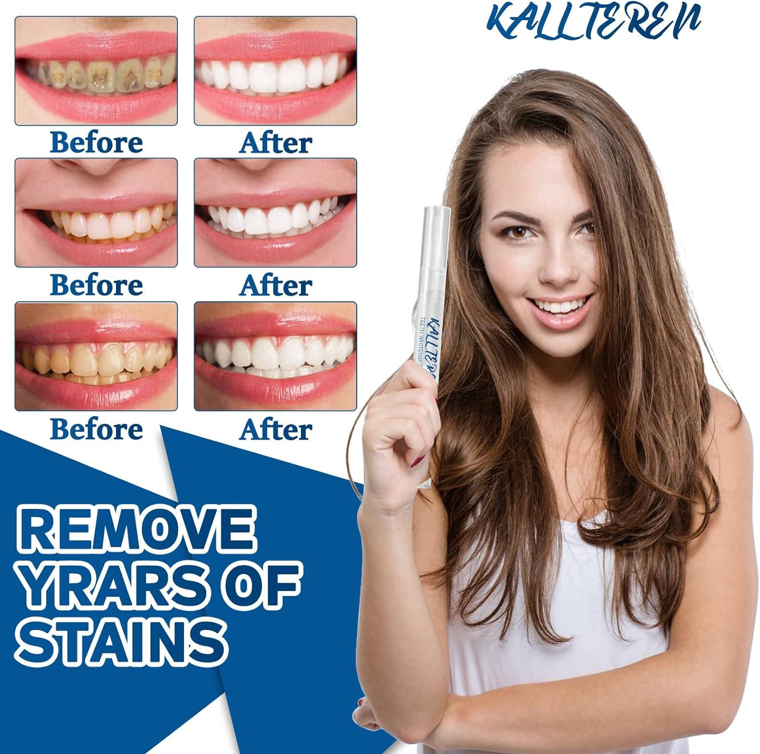 Teeth Whitening Pen(2 Pens) Teeth Whitening Kit Without The Sensitivity