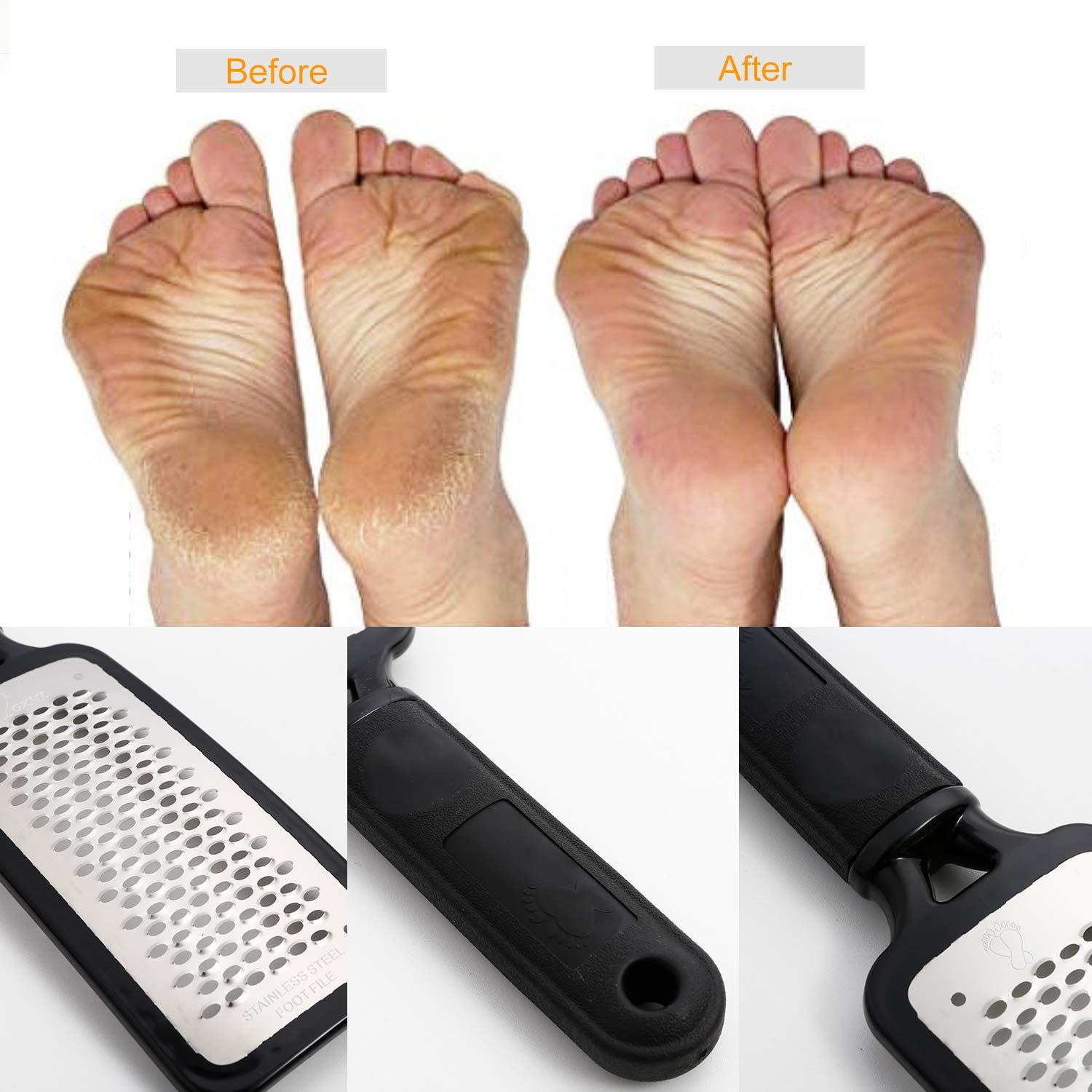 Professional Foot Scraper Set for Callus, Hard Skin Removal
