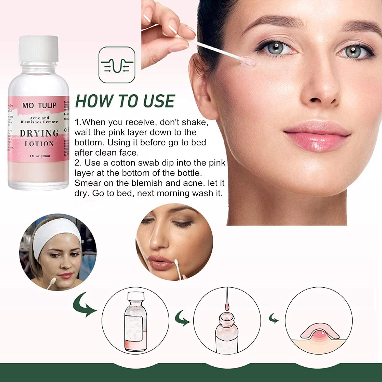 MO TULIP Acne Drying Lotion, Overnight Acne Acid and Acne Spot
