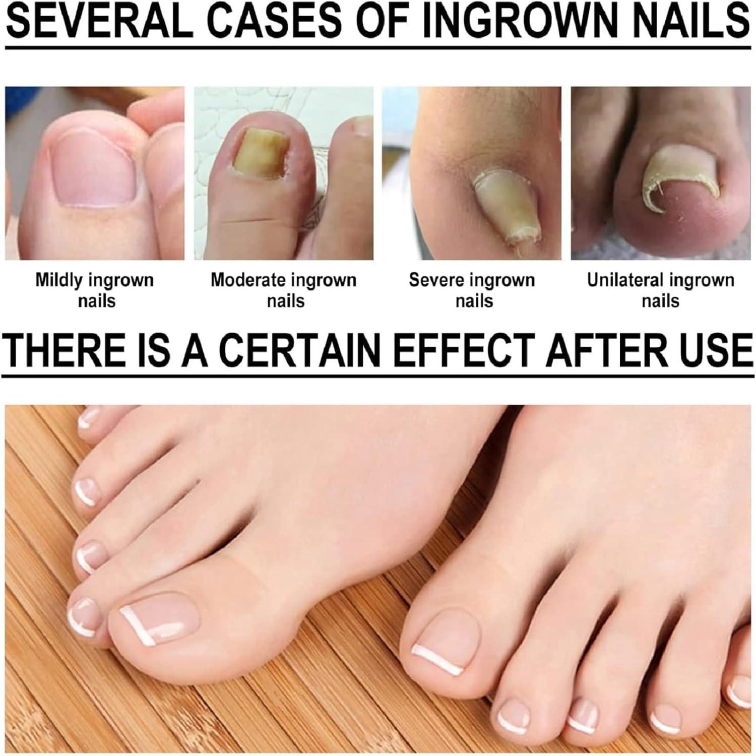 Ingrown Toenail Treatment Toenail Removal Ingrowing Toenail Treatment