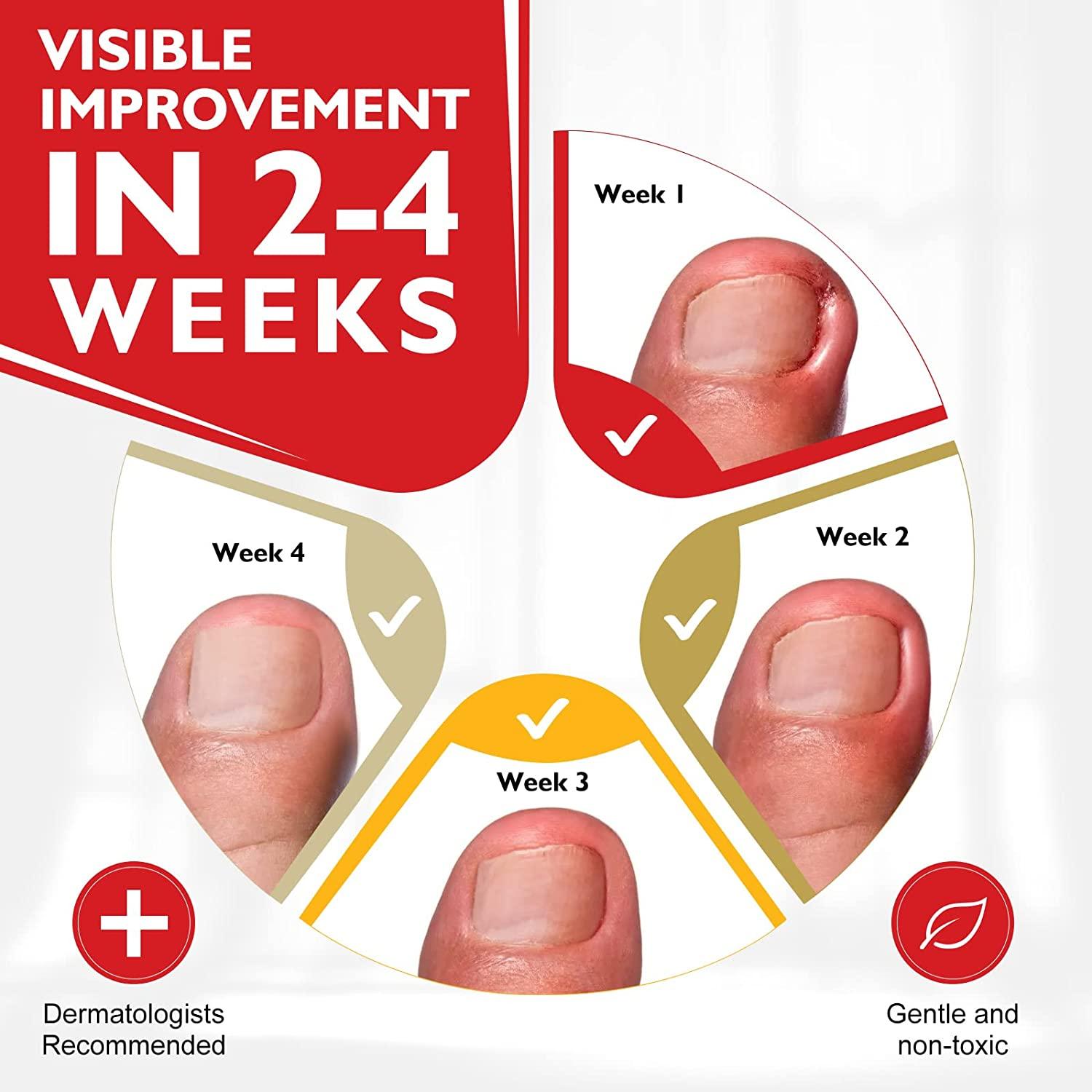 Natural Ingrown Toenail Treatment & Pain Relief Drops 30ml (1 bottle)