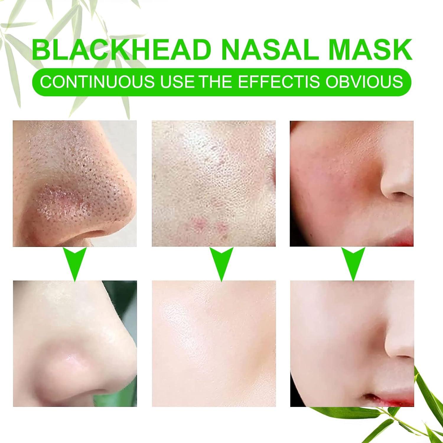 Finally! A Dermatologist'S Guide To Eliminating Big Blackheads - 1wl2jsi