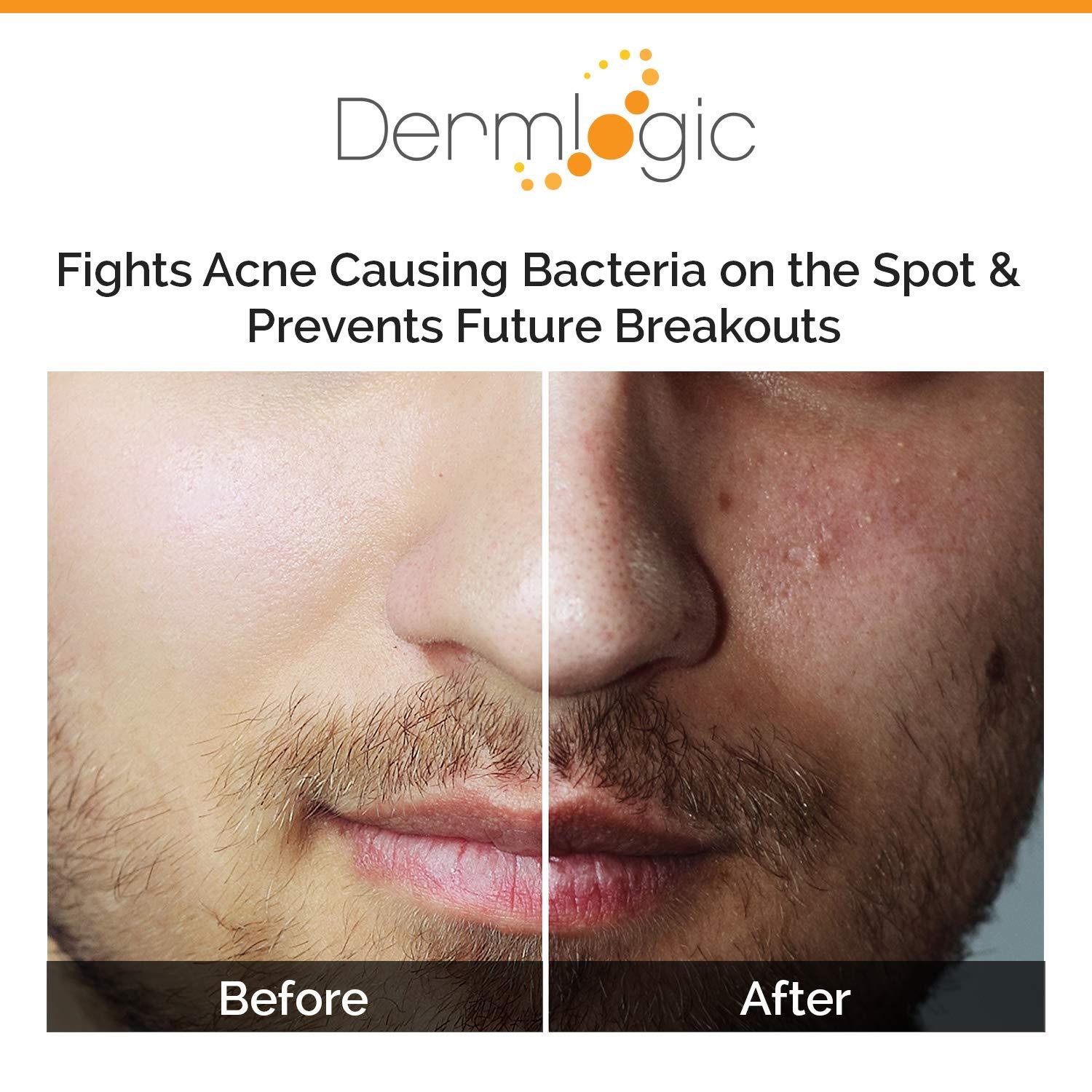 This Simple Home Remedy Clears Big Blackheads Overnight - trjto3m