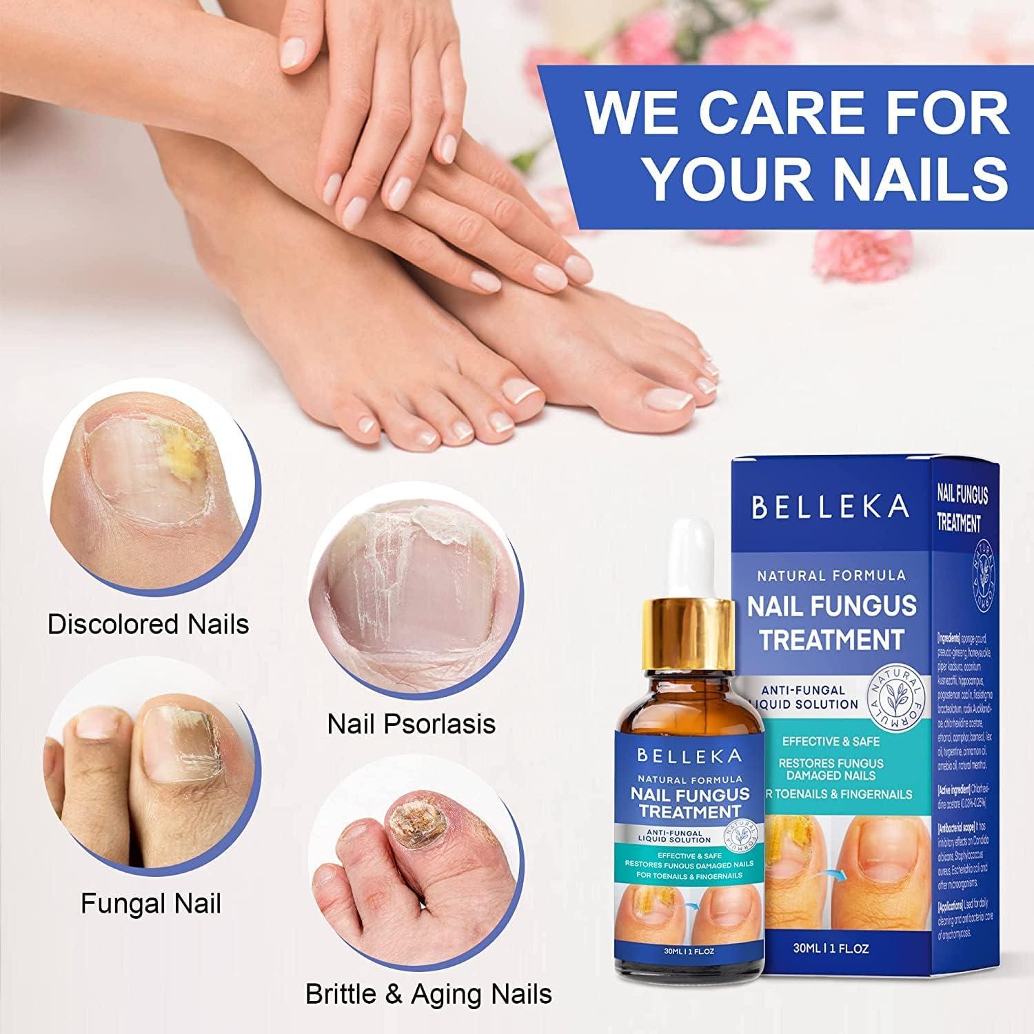 Fungal Nails - Hunter Podiatry Services