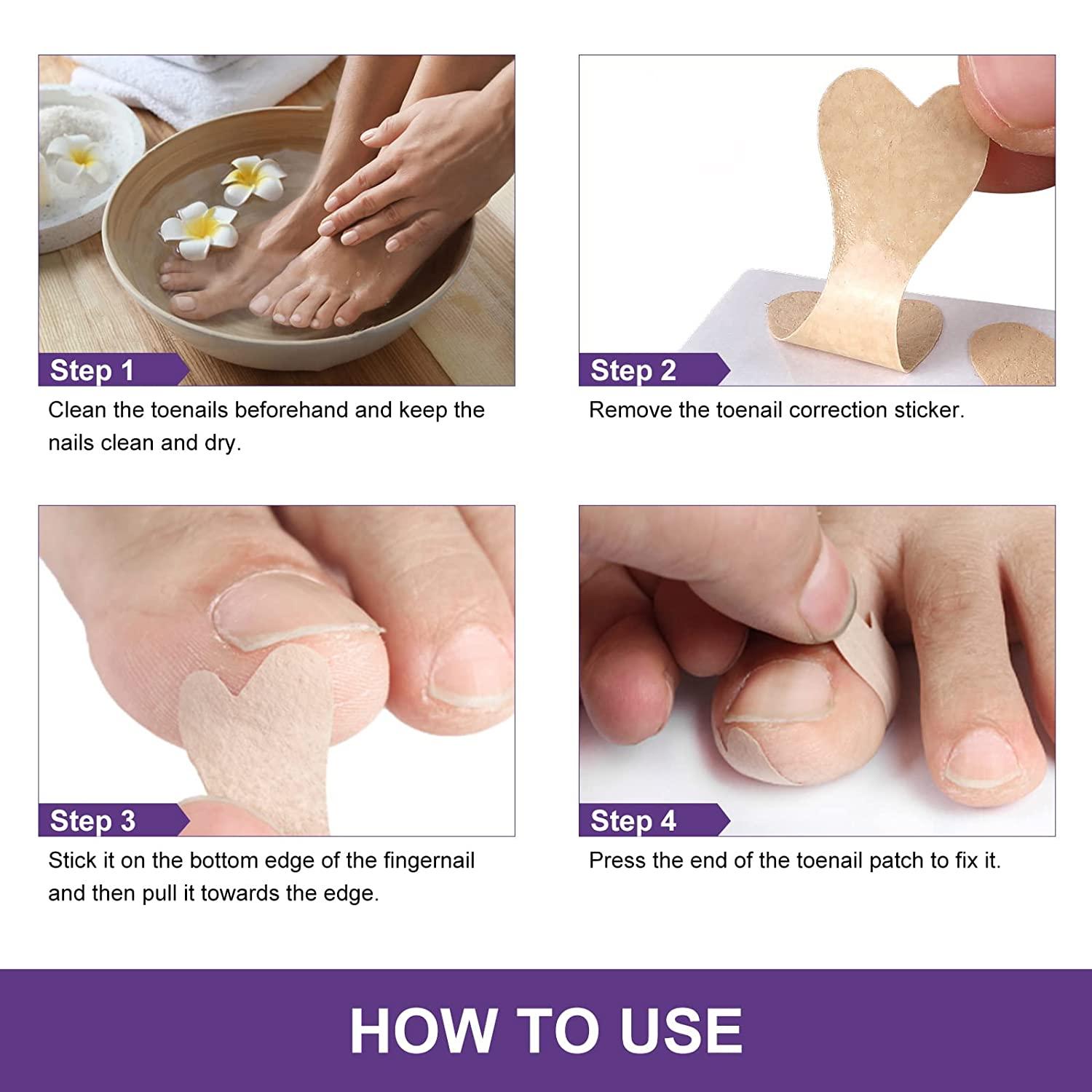IngrownToenailTreatment IngrownToenailPainRelief IngrownToenail