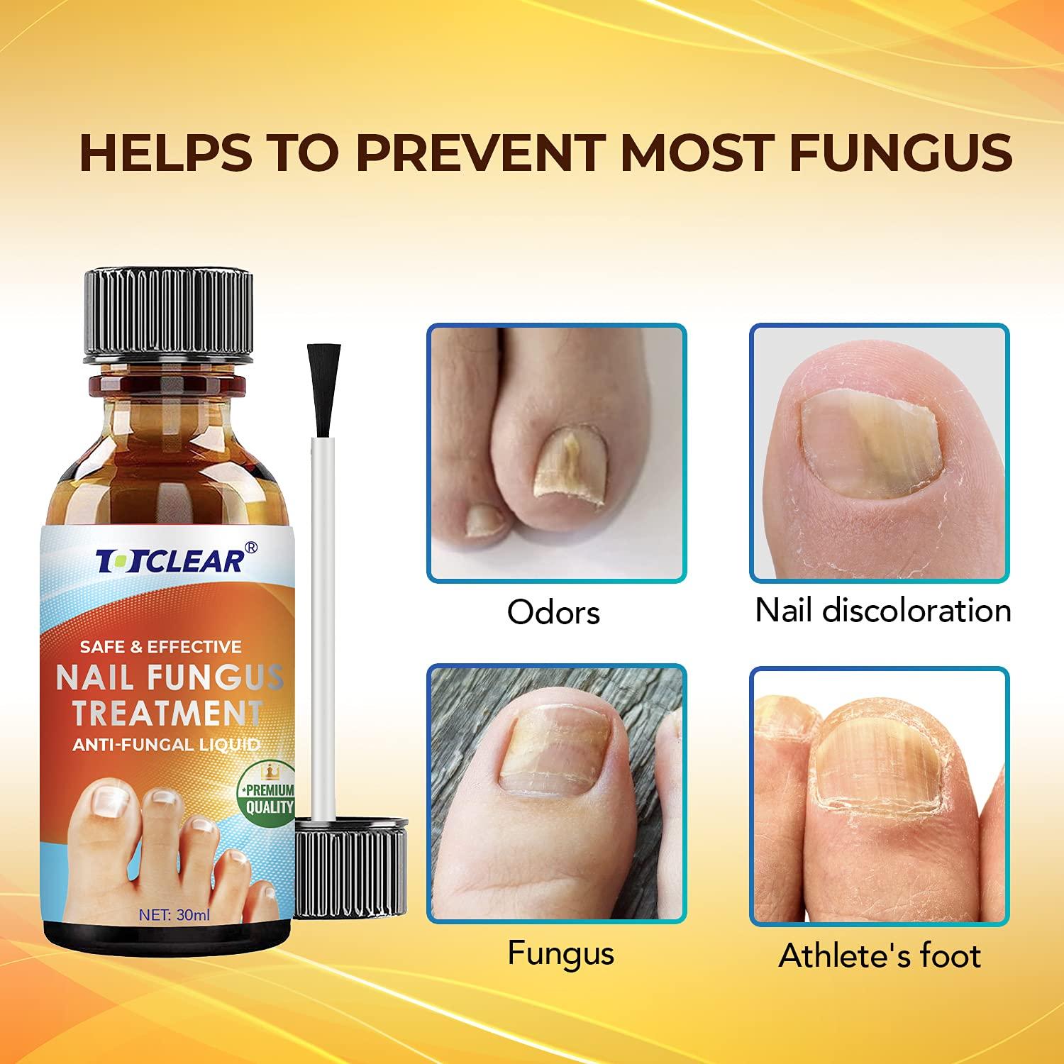 Nail Fungus Frequently Asked Questions | EMUAID®️