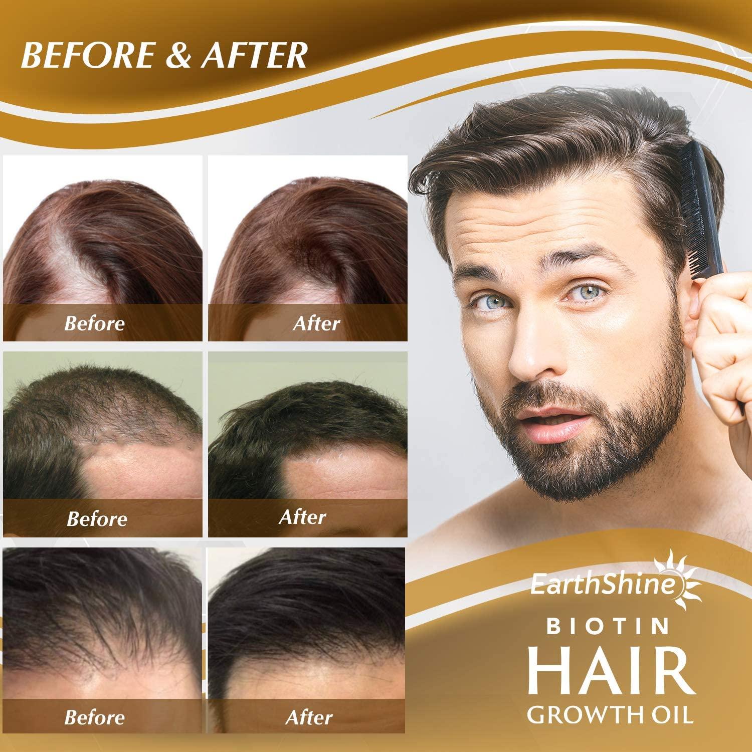 Hair Growth Serum - Biotin Hair Regrowth Oil Prevent Hair Loss and Natural  Serum for Thicker, Stronger, Longer Hair Treatment Men and Women  Oz  (35 mL) Single