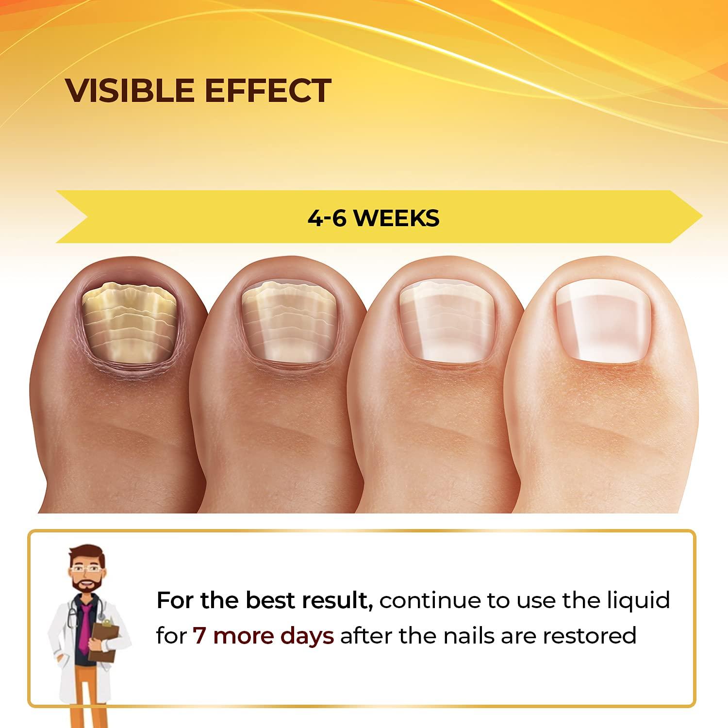 Caring For Your Feet After A Surgical Nail Removal - Sanara MedTech