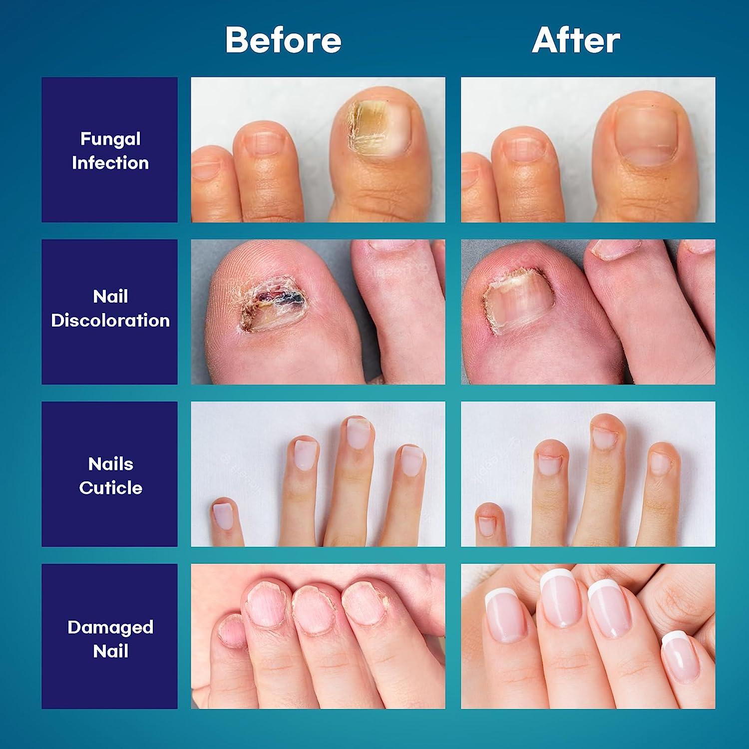 Fungal nail infections | Healthify