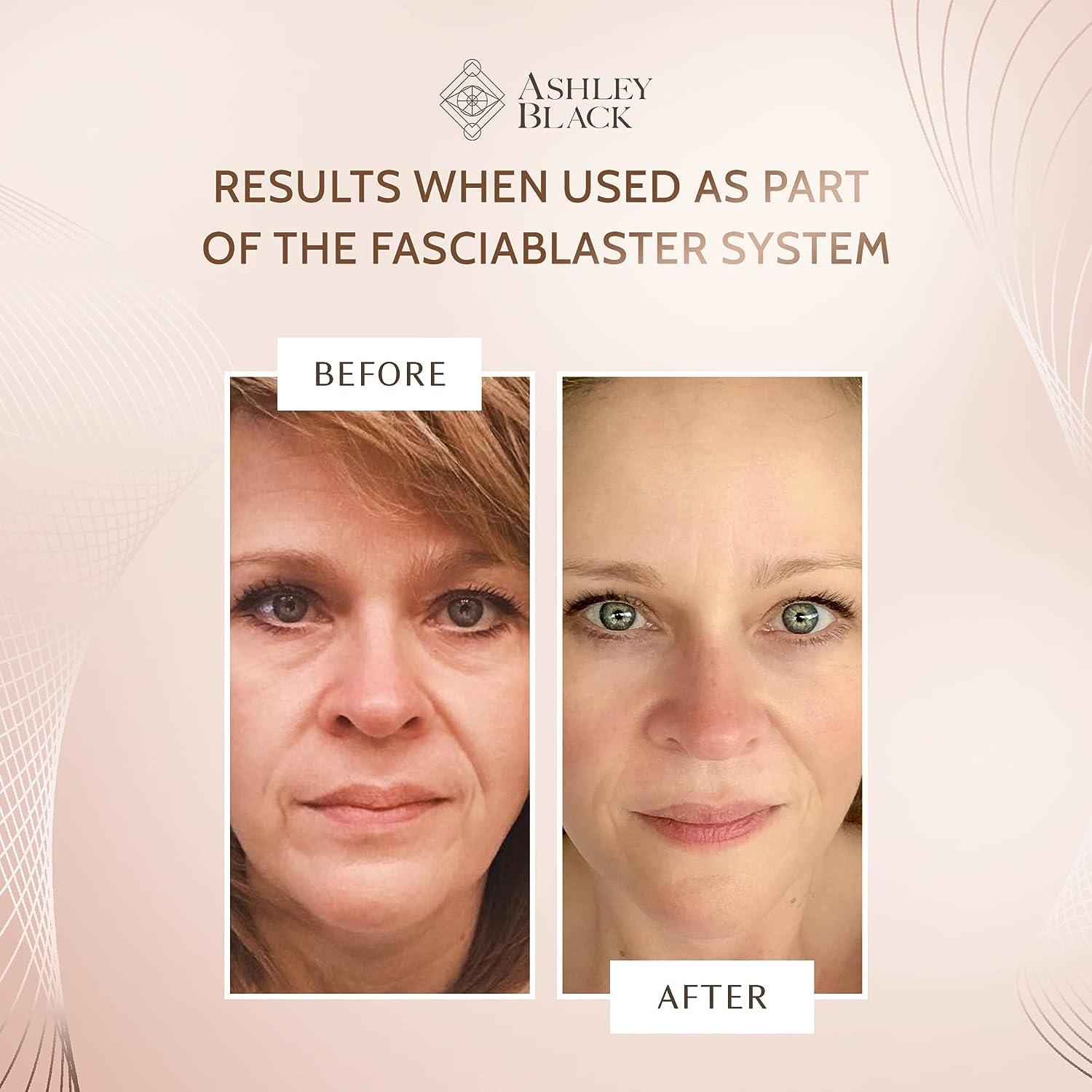 Single Claw FasciaBlaster by Ashley Black Face Wrinkle Blaster