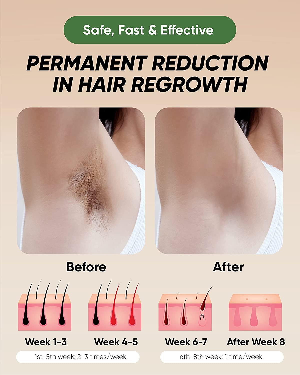 XSOUL At-Home IPL Hair Removal for Women and Men Permanent Hair Removal  999999 Flashes Painless Hair Remover on Armpits Back Legs Arms Face Bikini  Line Corded
