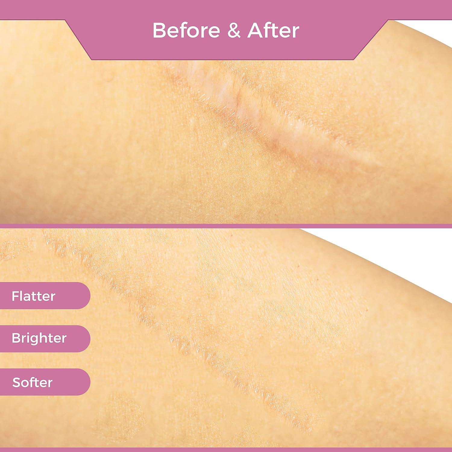 Silicone Scar Tape Scar Sheet Upgrade Professional Medical Scar