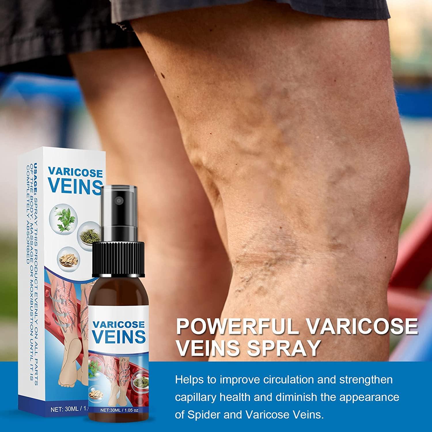 Varicose Veins Miracle Spray Treatment for Legs to Improve Blood