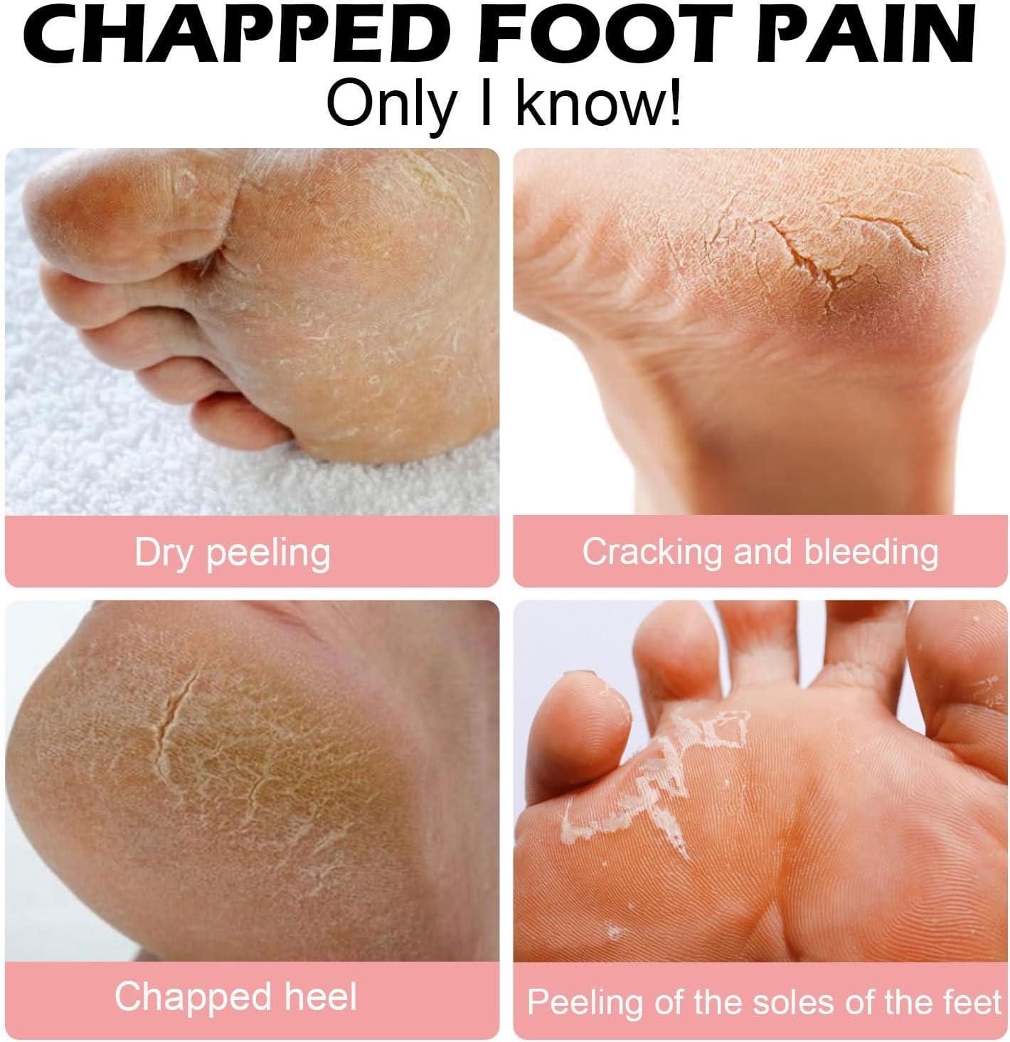 Callus Badly Cracked Heel Dry Cracked Heel And Callus On The Foot