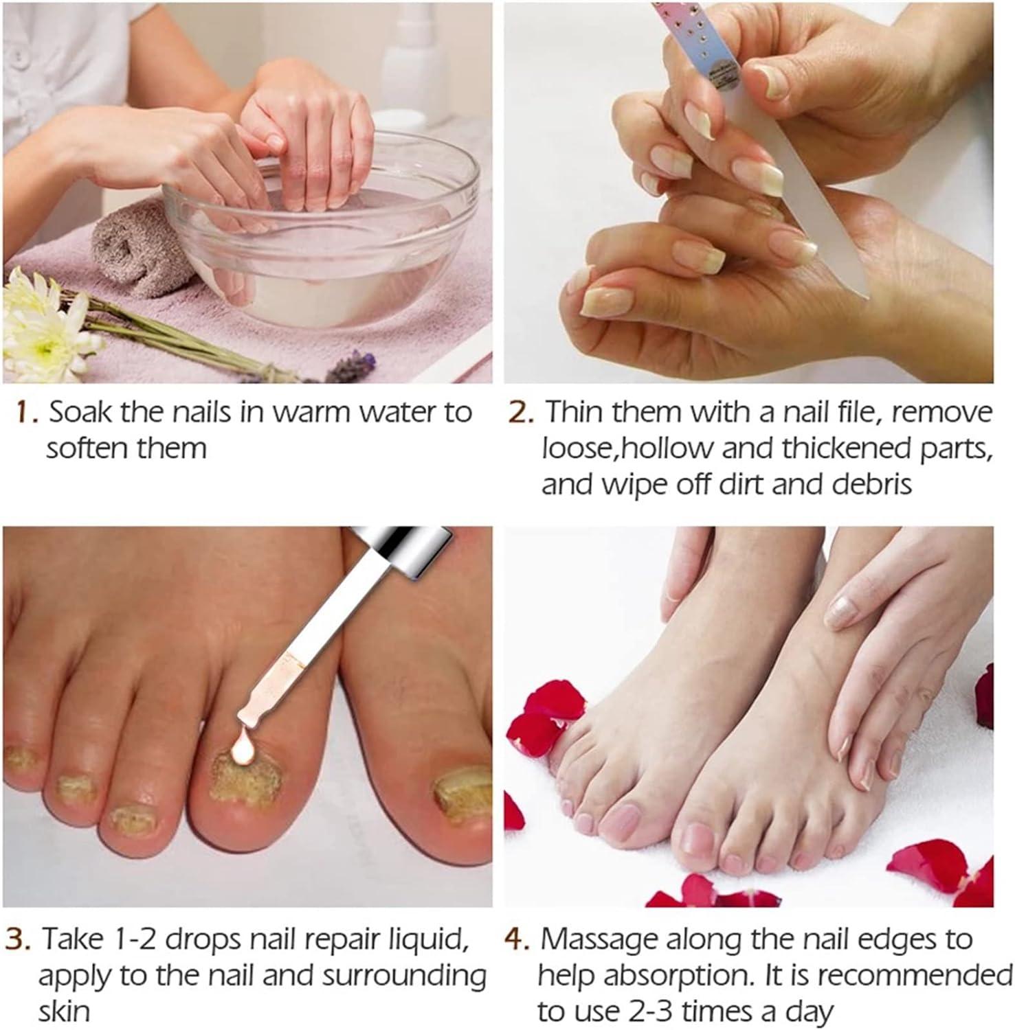 Fungal Nail Treatment 20ml Extra Strong Nail Fungus Treatment for Toenail and Fingernail Premium