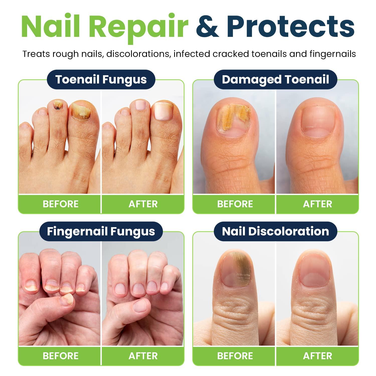 PODERM - NAIL HARDENER AND STRENGTHENER | Repairs cracked, split, and broken  nails with plant-based treatment | Professional foot and hand care | Eas -  Imported Products from USA - iBhejo