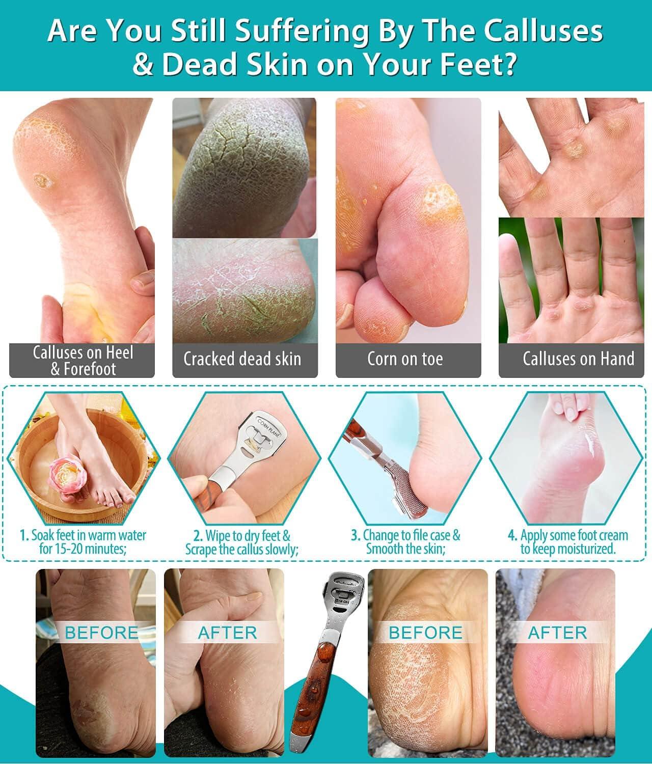 Foot Hard Dead Skin Scraper Remover Pedicure Care Feet Callus Corn Shaver  Blades 