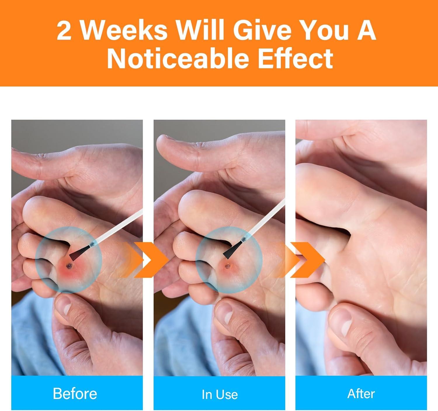 Corn Removers for Feet Extra Strength Foot Corn Remover Liquid Corn & Callus Remover for Toes 30ml