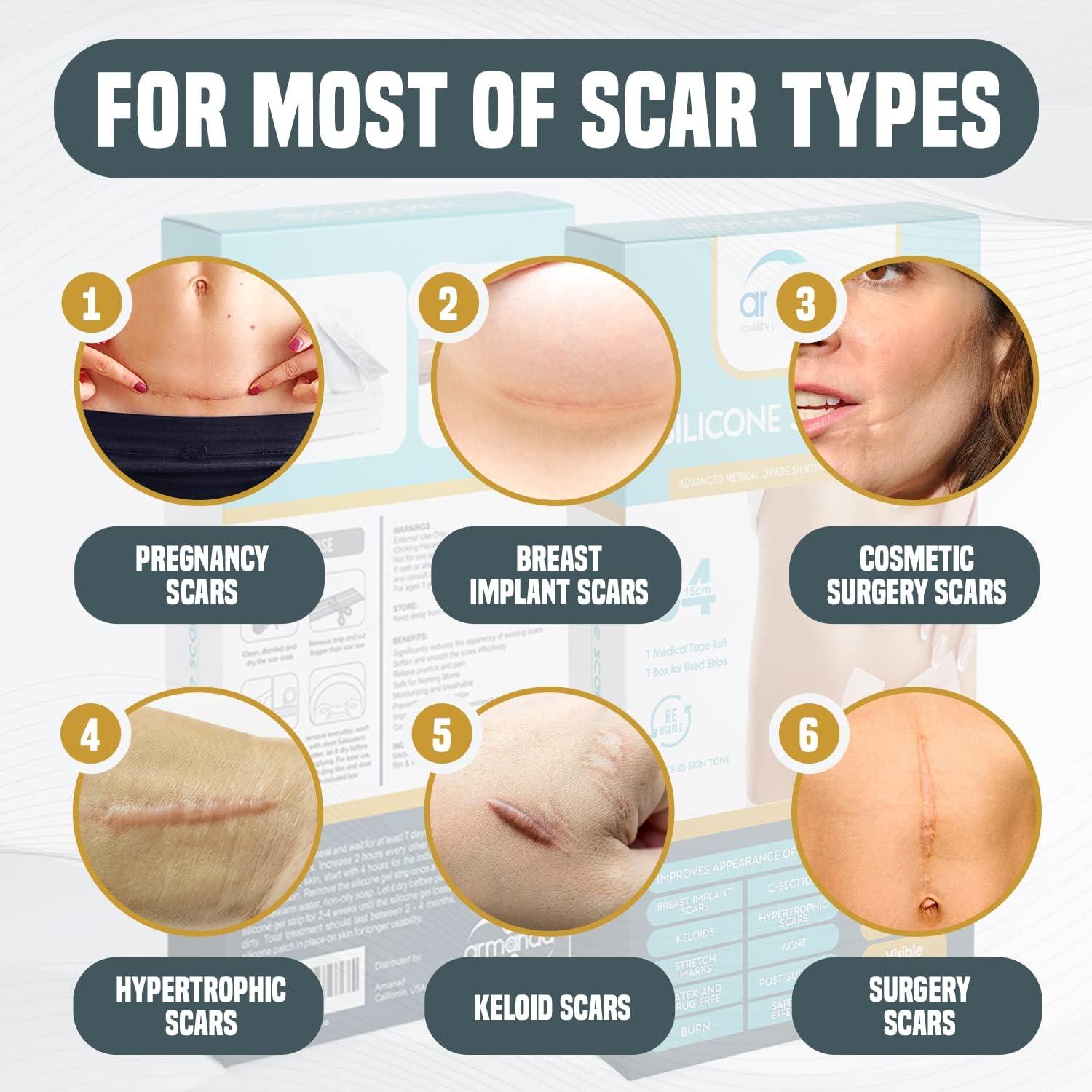 Armanad Silicone Strips for Scar Healing Silicone Scar Sheets Stripes