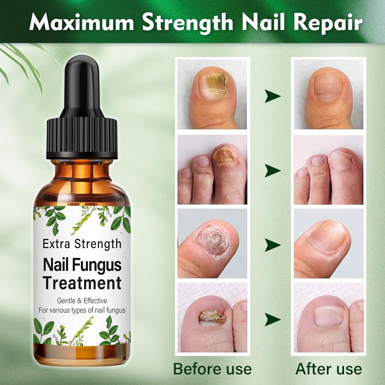 Fungal Nail Treatment Toenail Fungus Treatment Extra Strong Nail Repair
