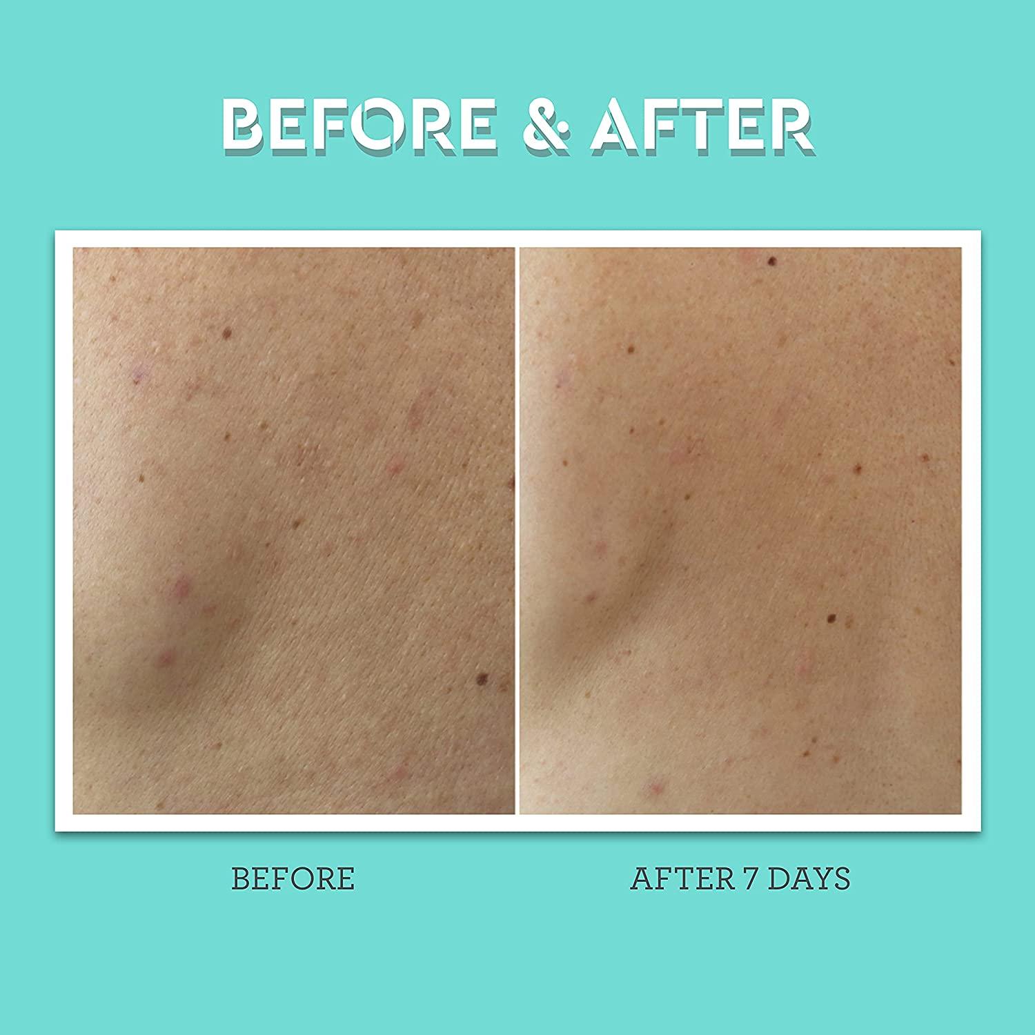 Bliss Clear Genius Body Acne Spray Maximum Strength 2 Salicylic Acid