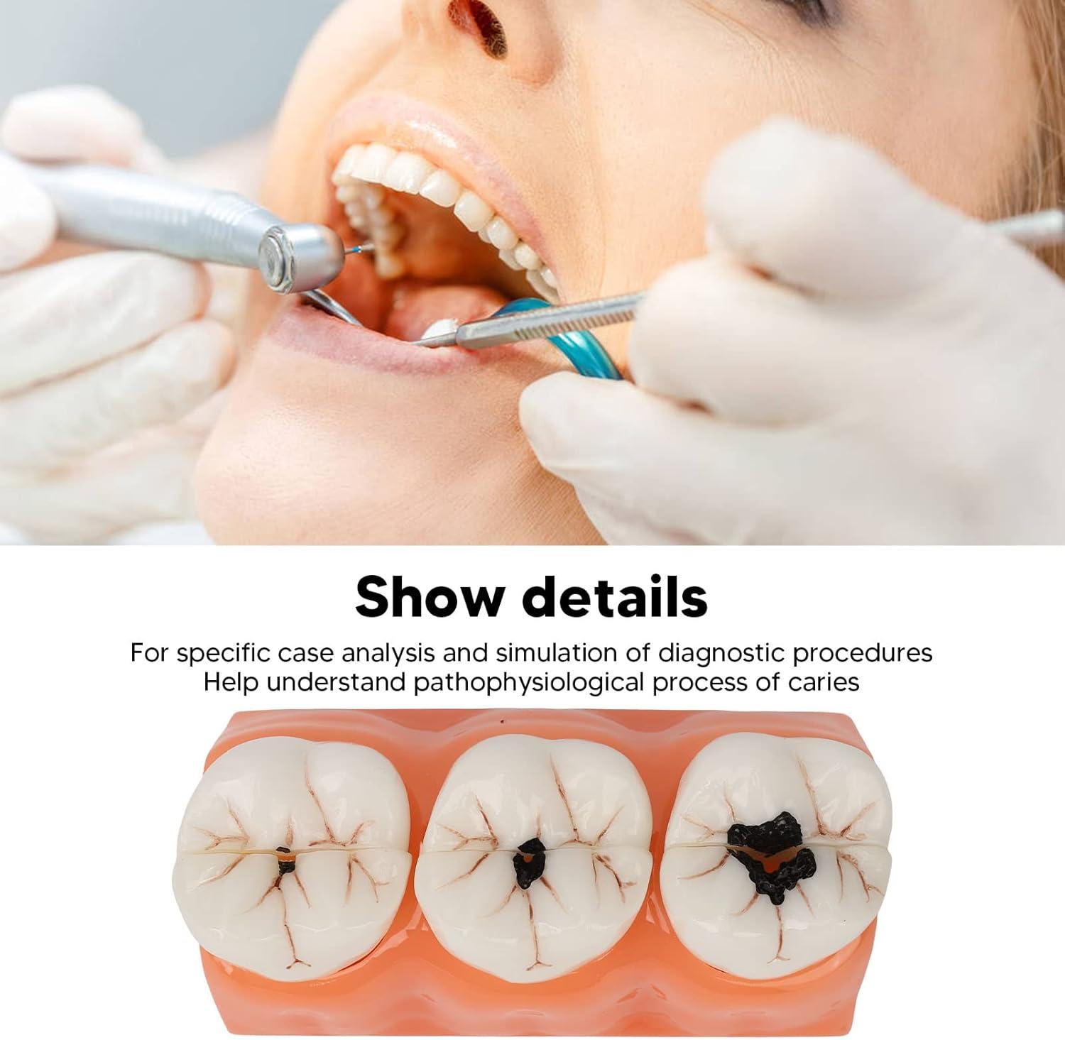 4-Fold Dental Caries Model - Synthetic Resin Oral Care Training Tool ...