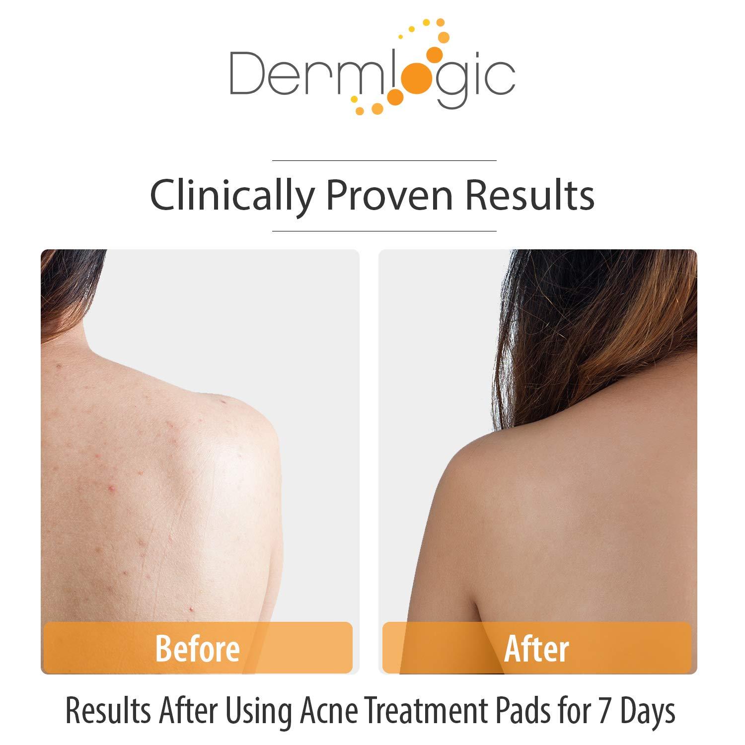Dermlogic Acne Treatment PadsContains Glycolic, Lactic, Salicylic Acid