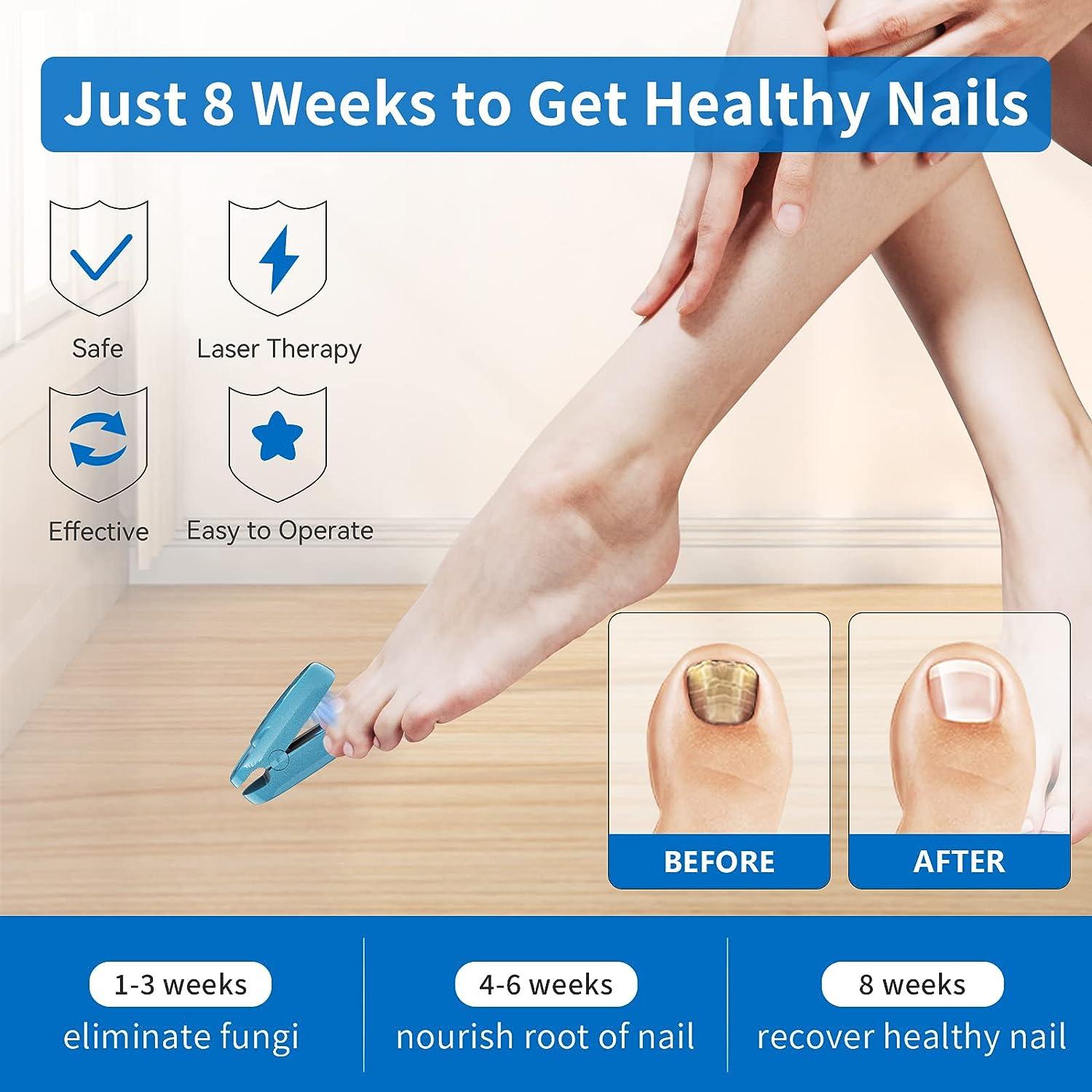 OUR TREATMENTS | Fungal Nail Solutions