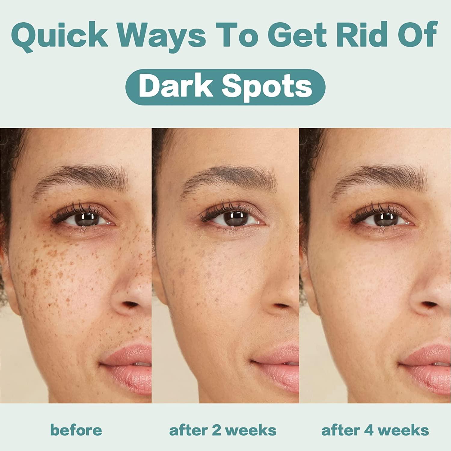 CITYGOO Dark Spot Remover Cream for Face & Body Natural Skin Care for